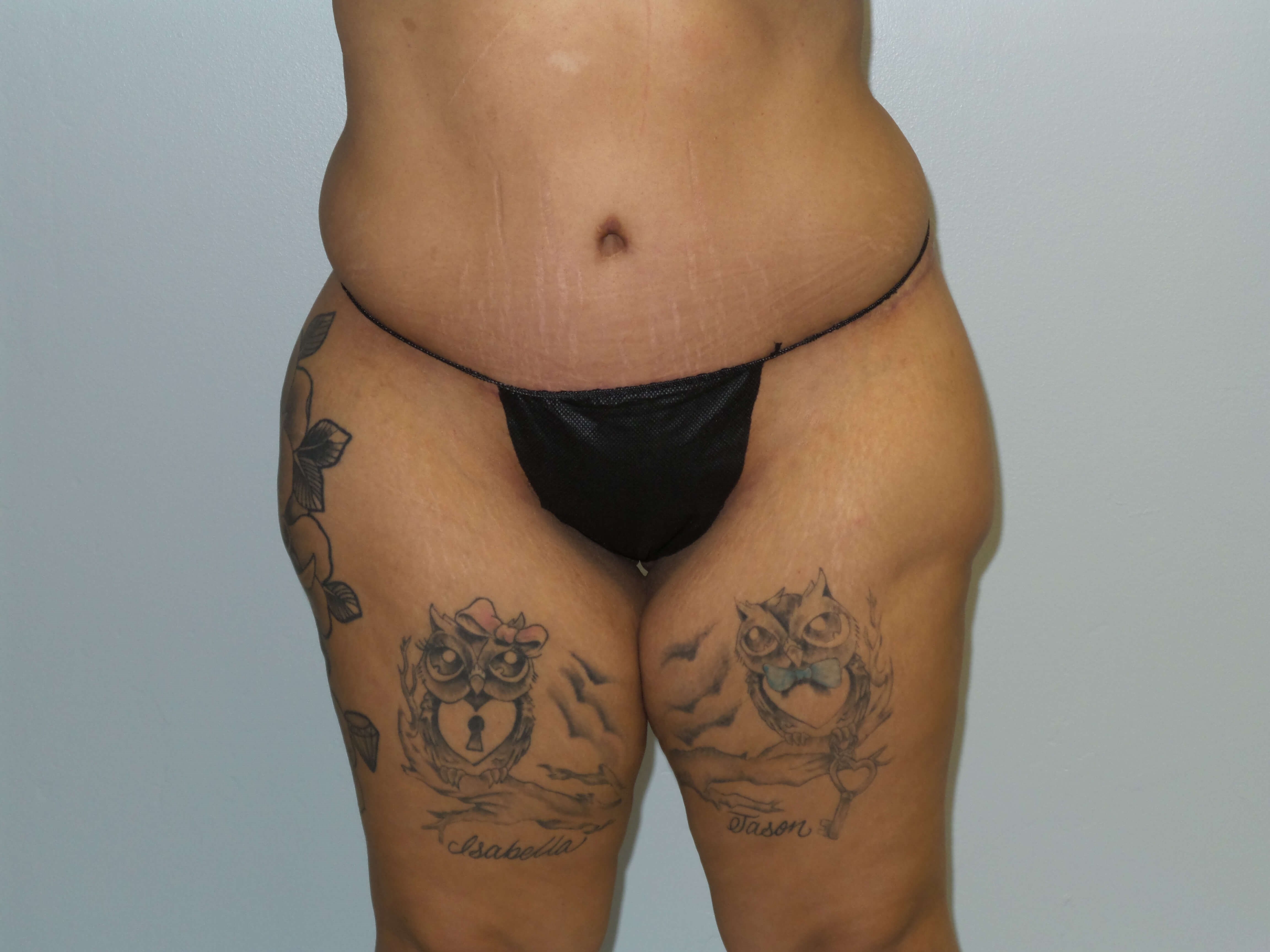 Woman has BBL Butt Lift Before