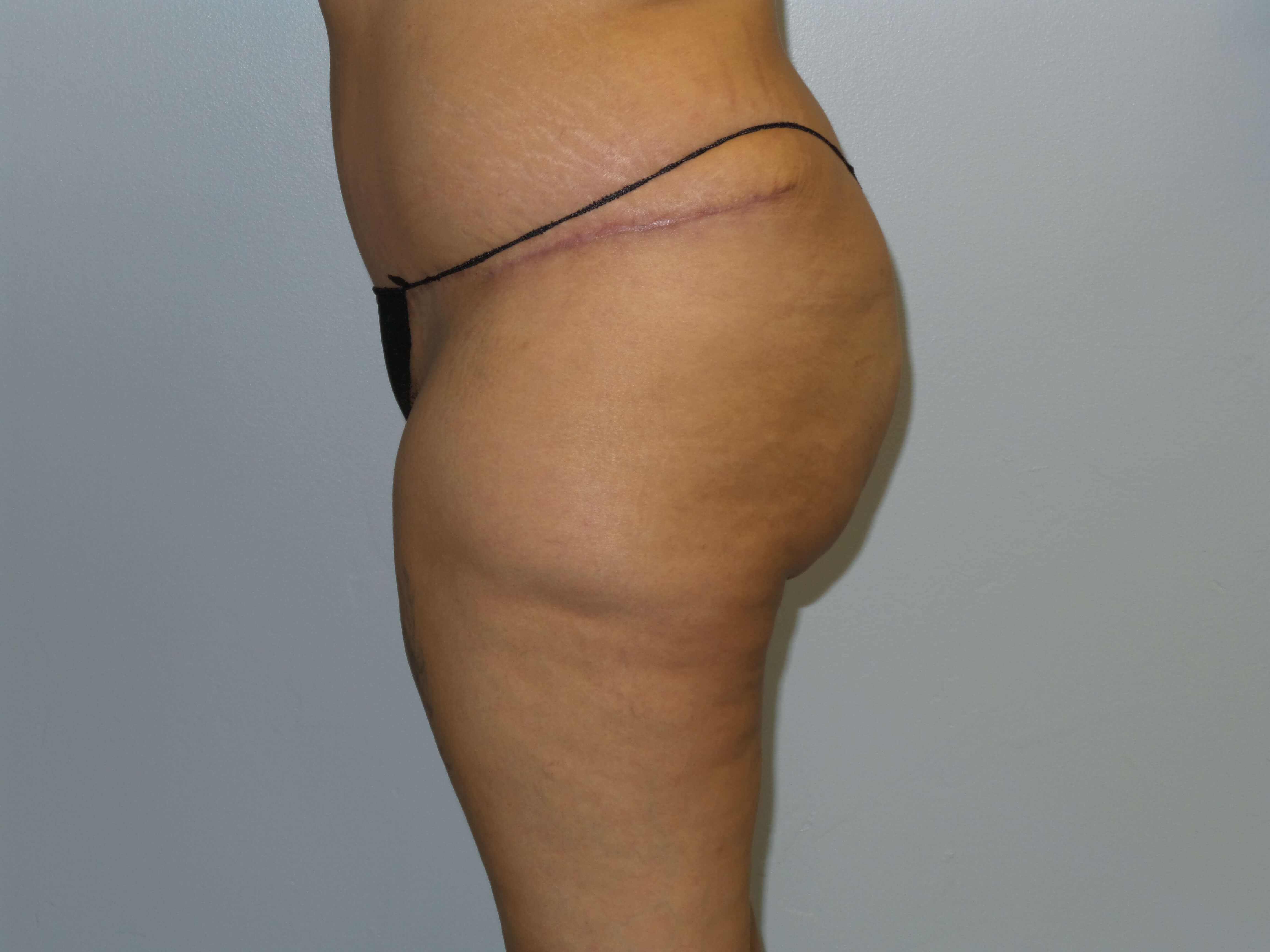 Woman has BBL Butt Lift Before