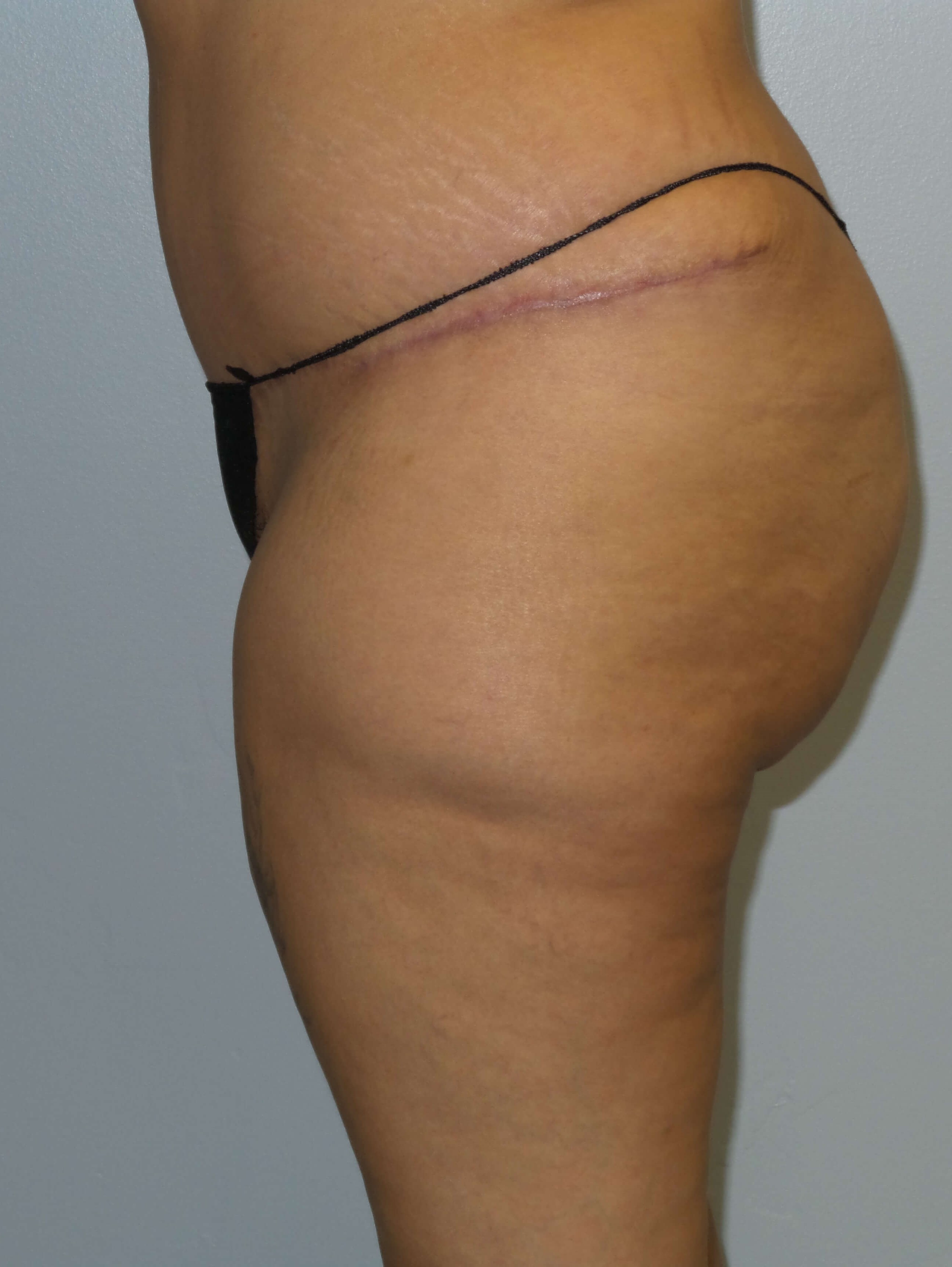Woman has BBL Butt Lift Before