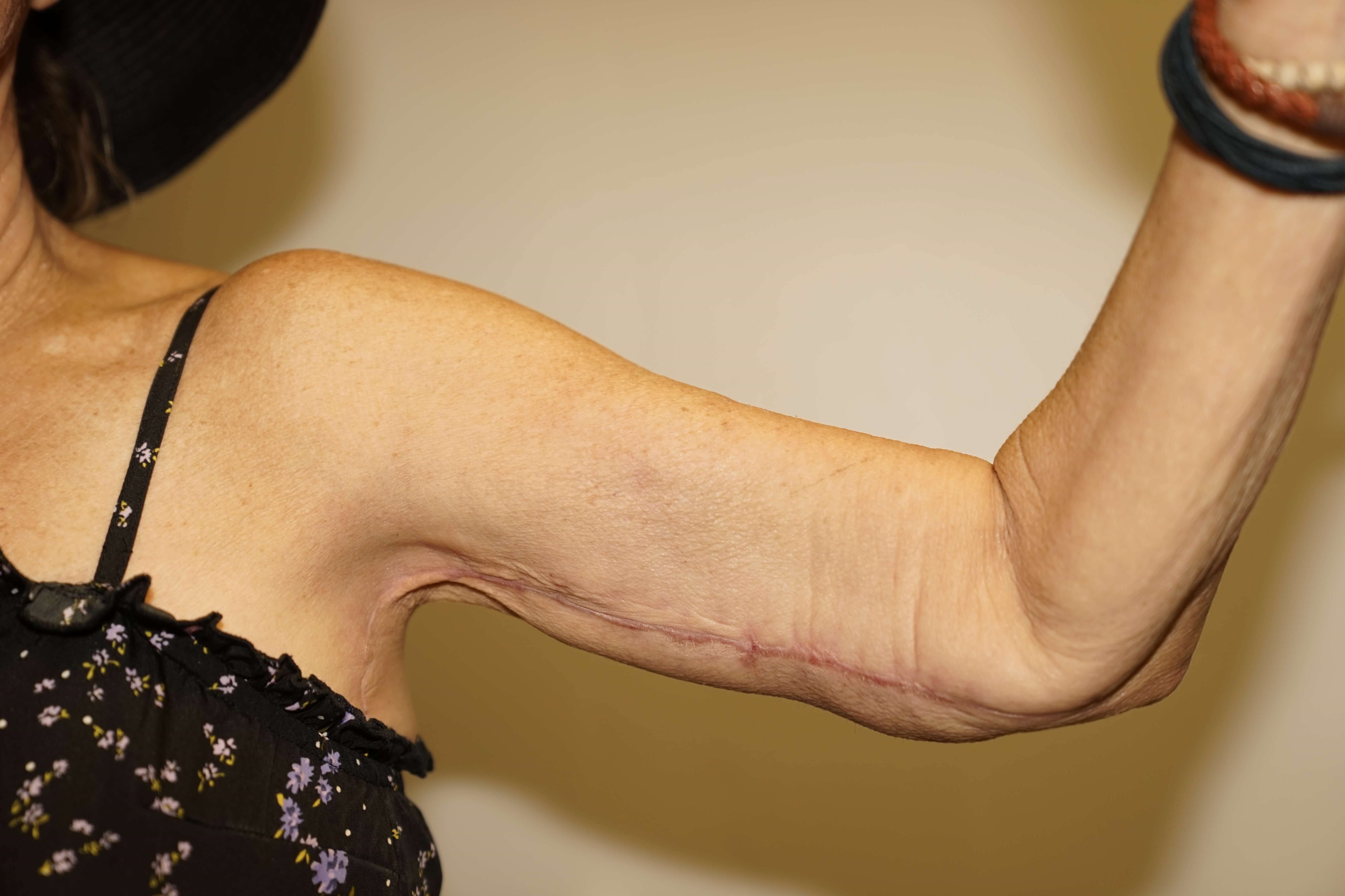 Woman has Brachioplasty After