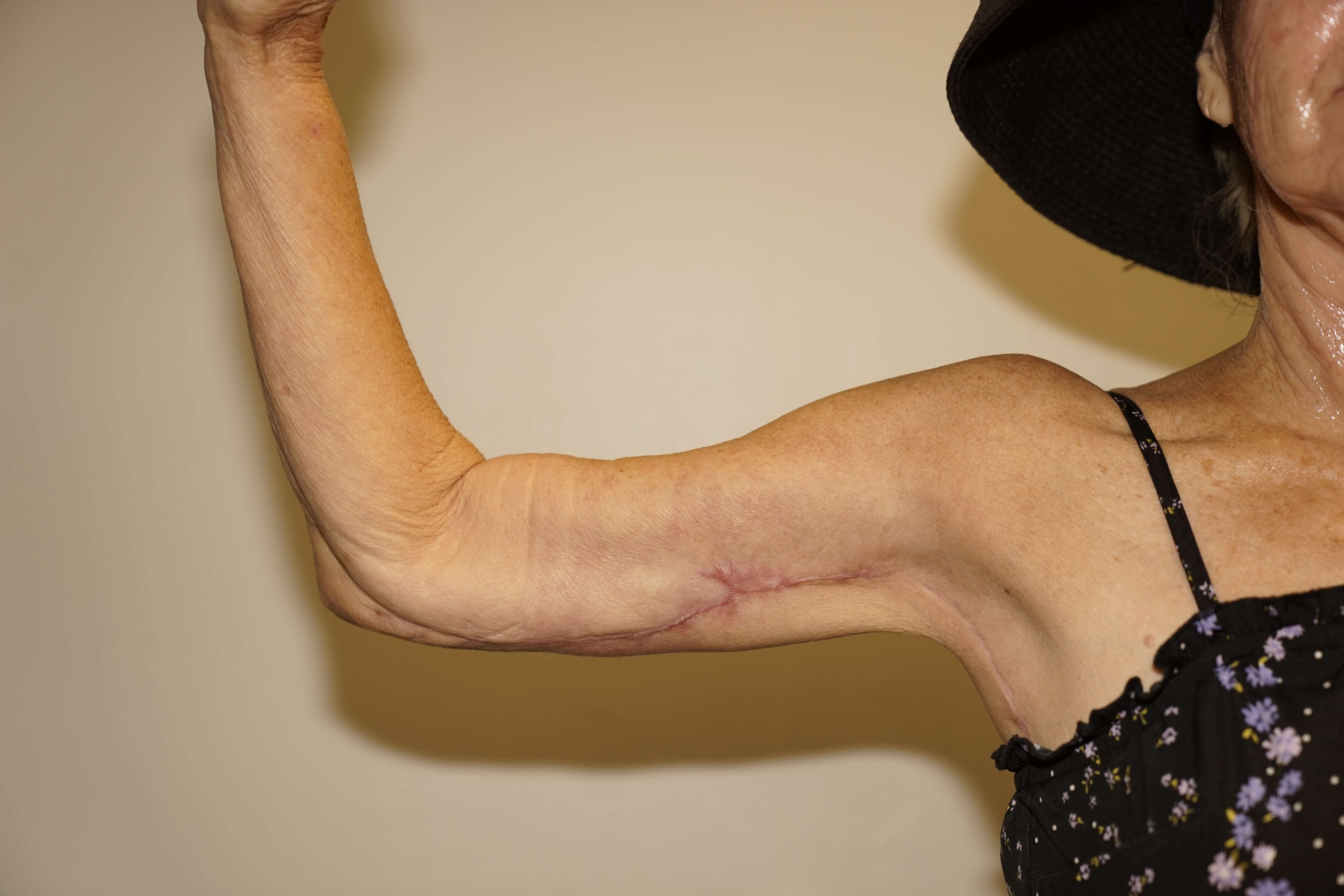 Woman has Brachioplasty After