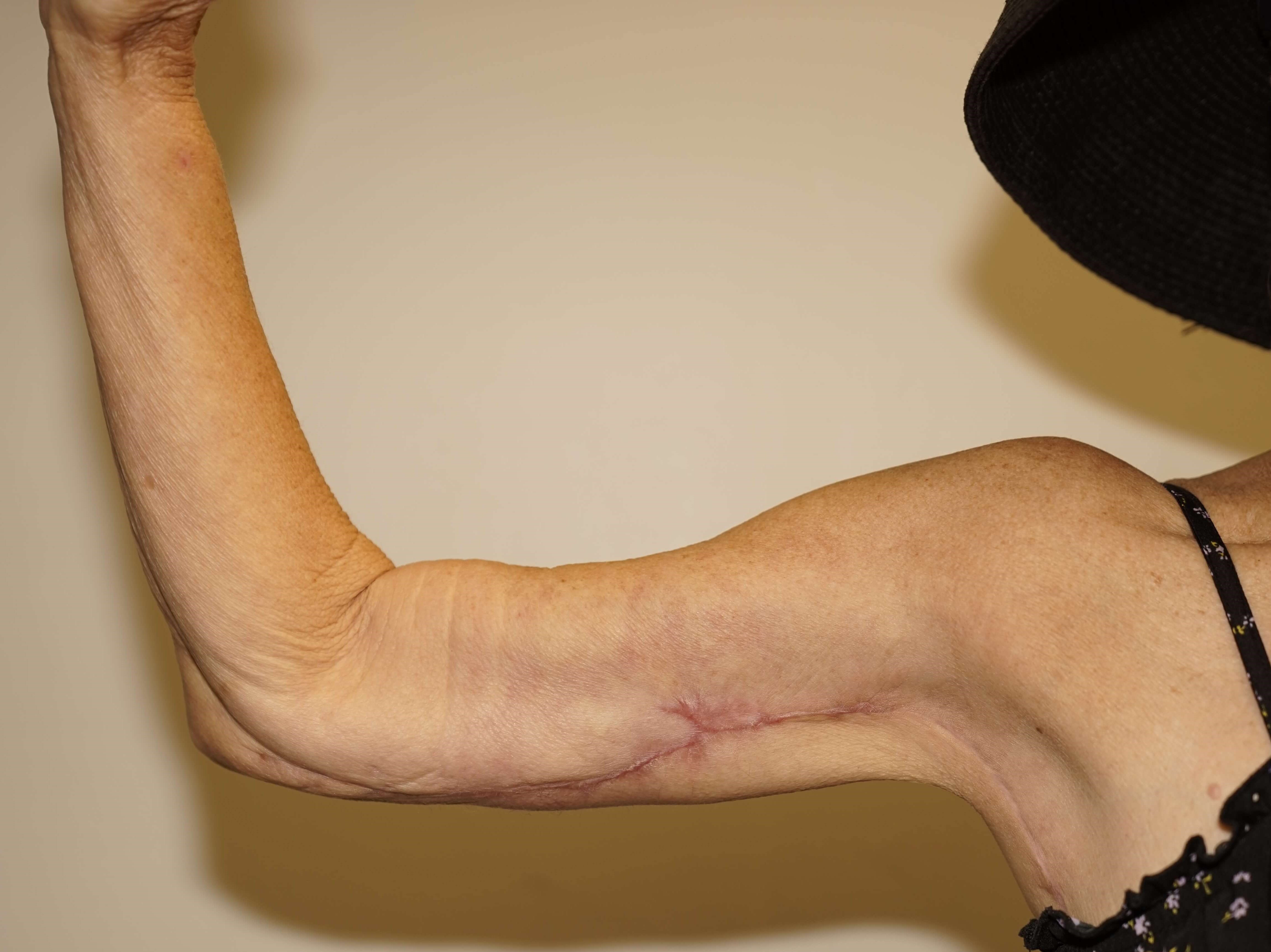 Woman has Brachioplasty After