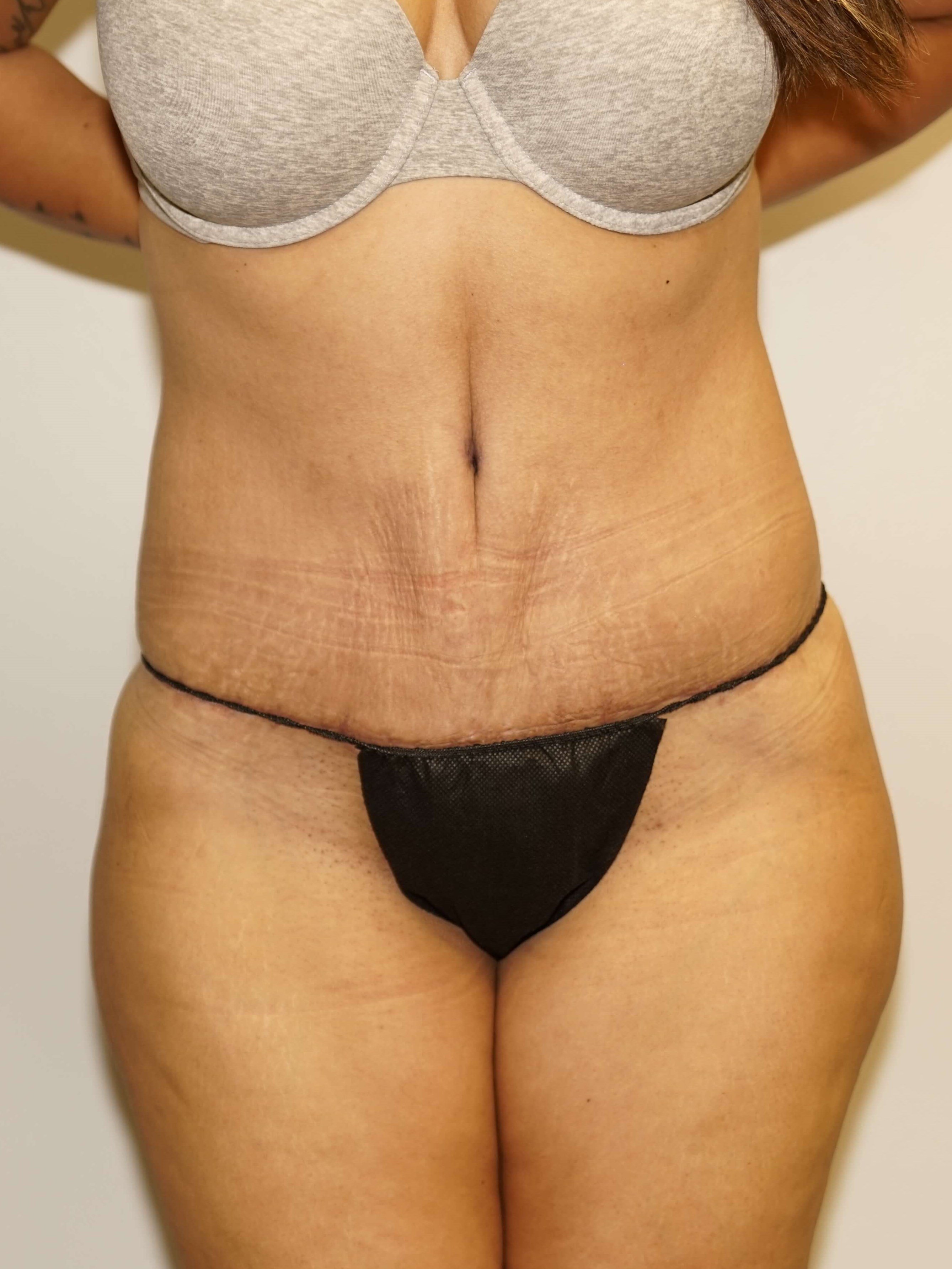 Woman Has Tummy Tuck Lipo After
