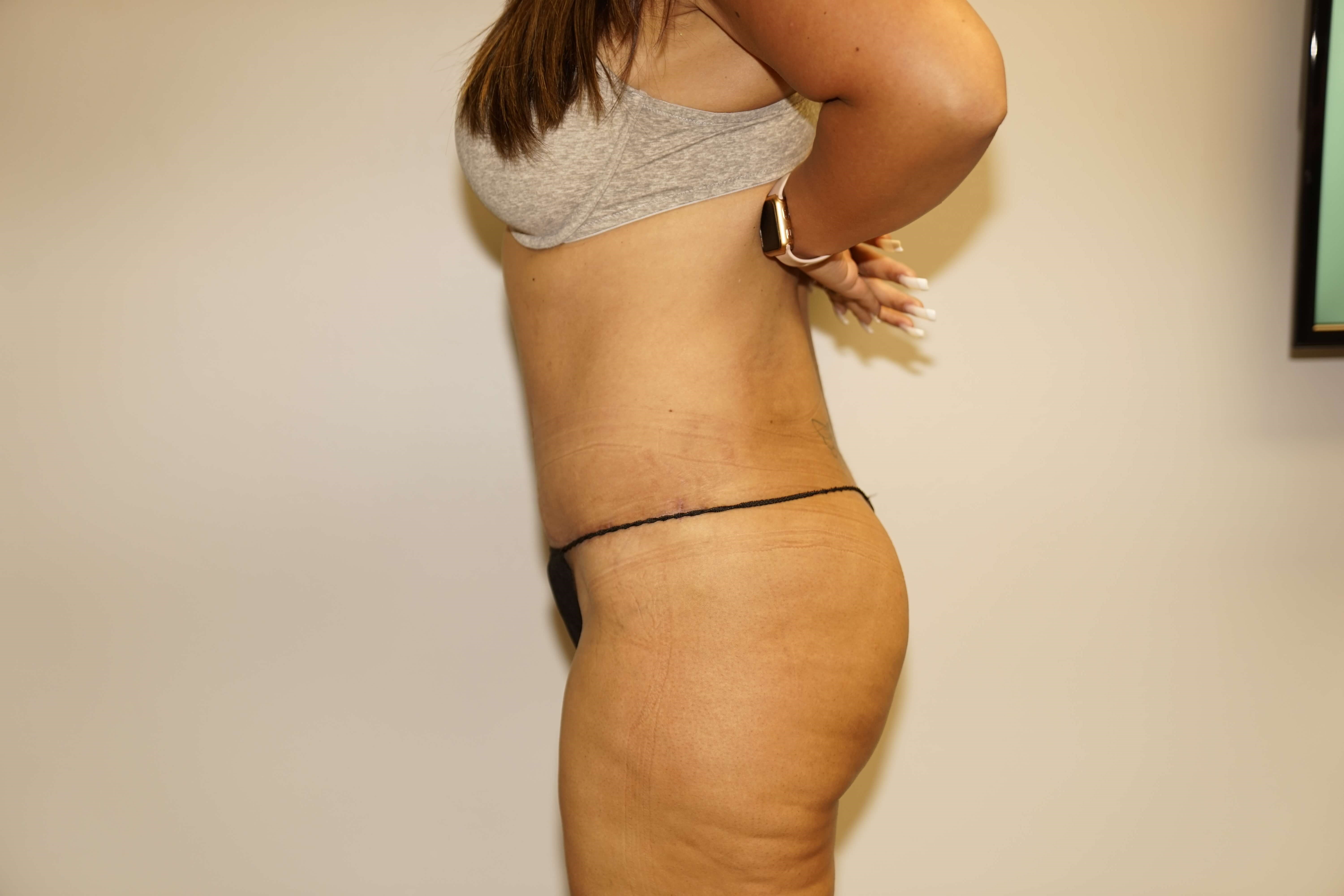 Woman Has Tummy Tuck Lipo After