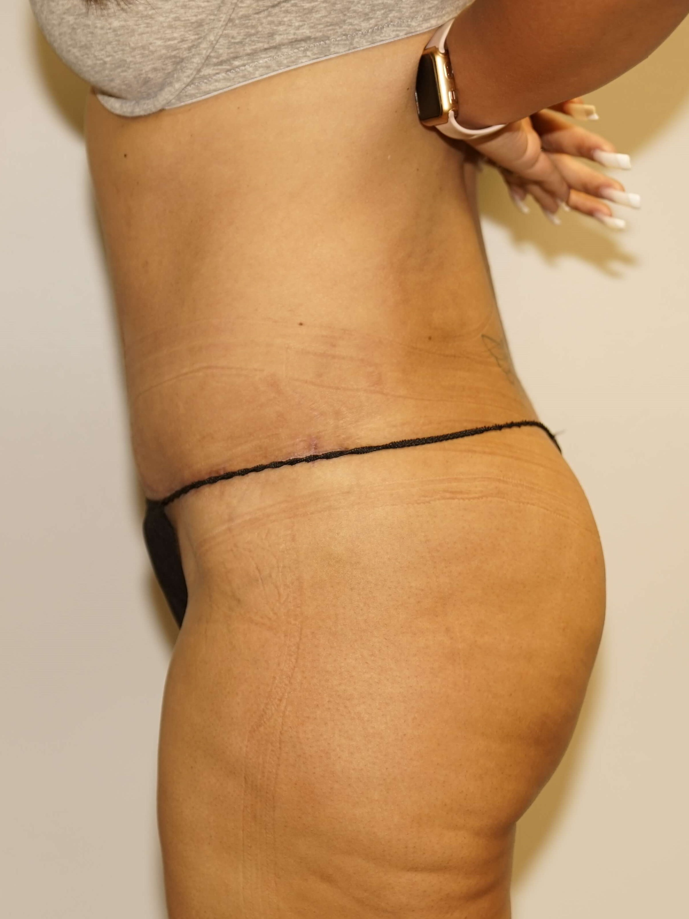 Woman Has Tummy Tuck Lipo After