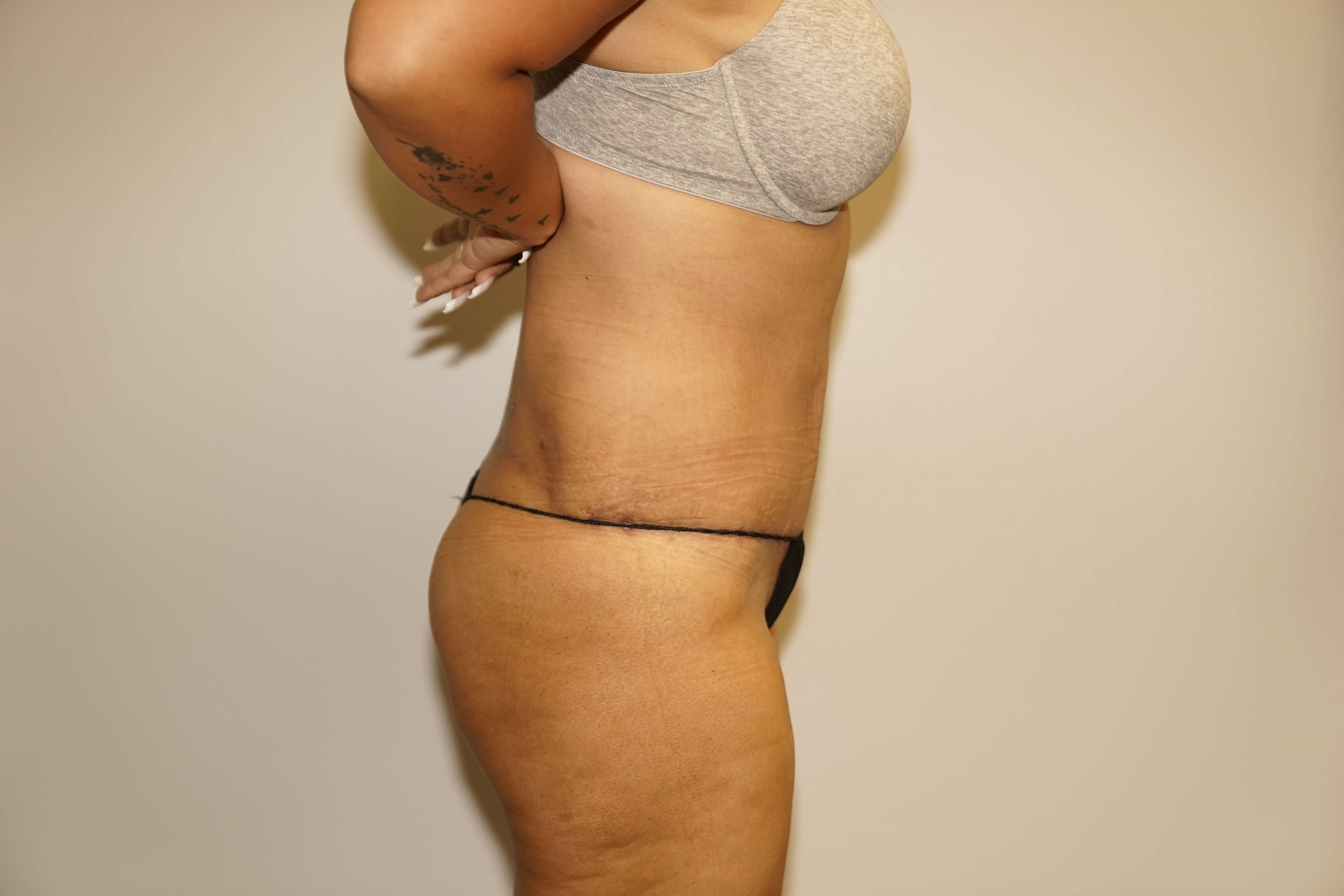 Woman Has Tummy Tuck Lipo After