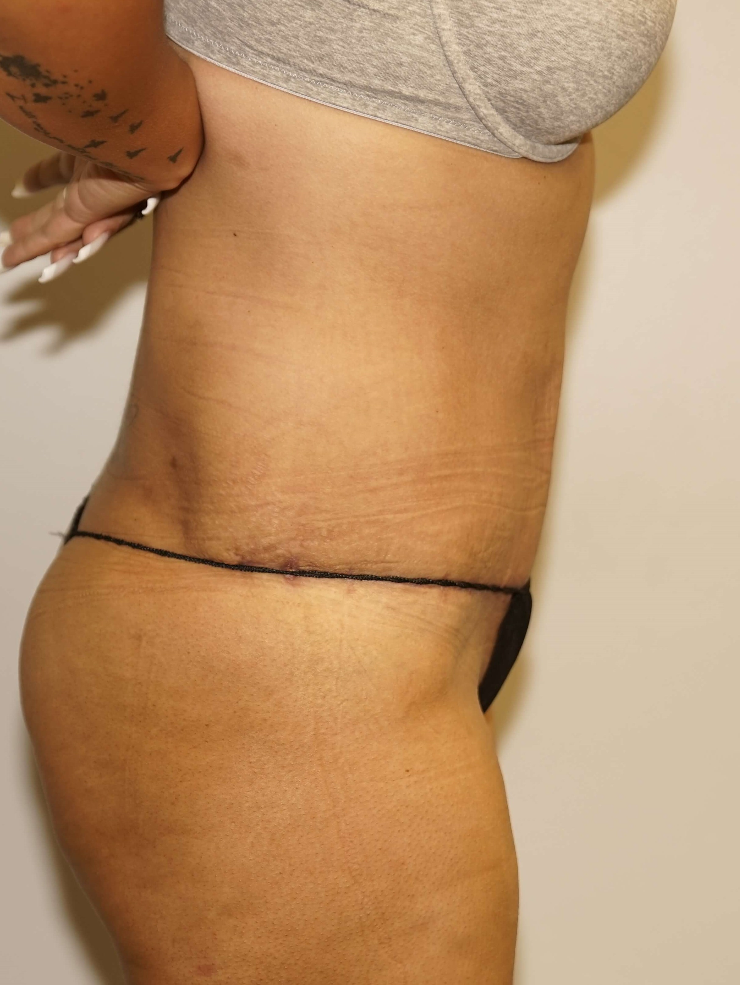Woman Has Tummy Tuck Lipo After