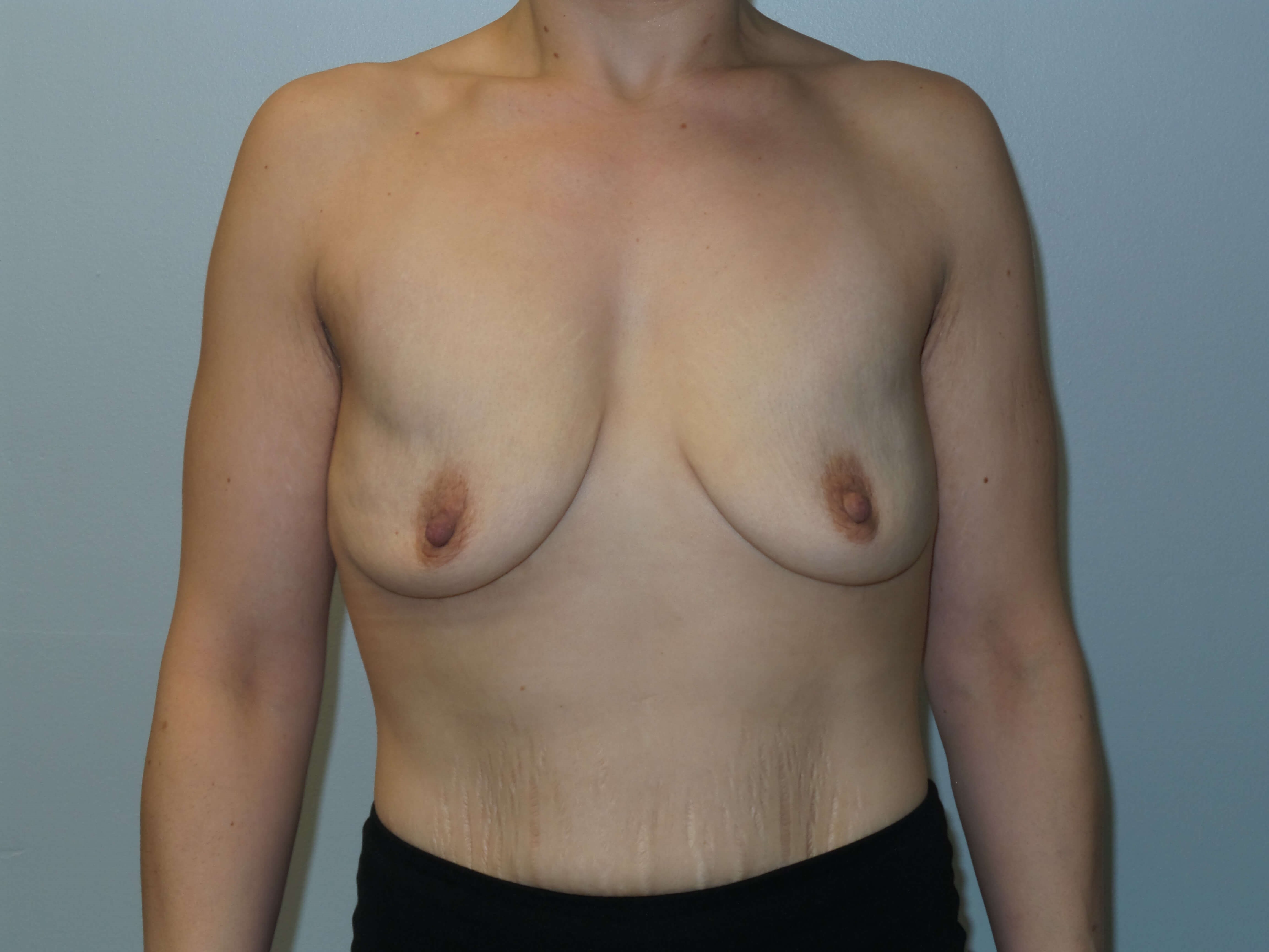Westlake Woman Has Breast Aug Before