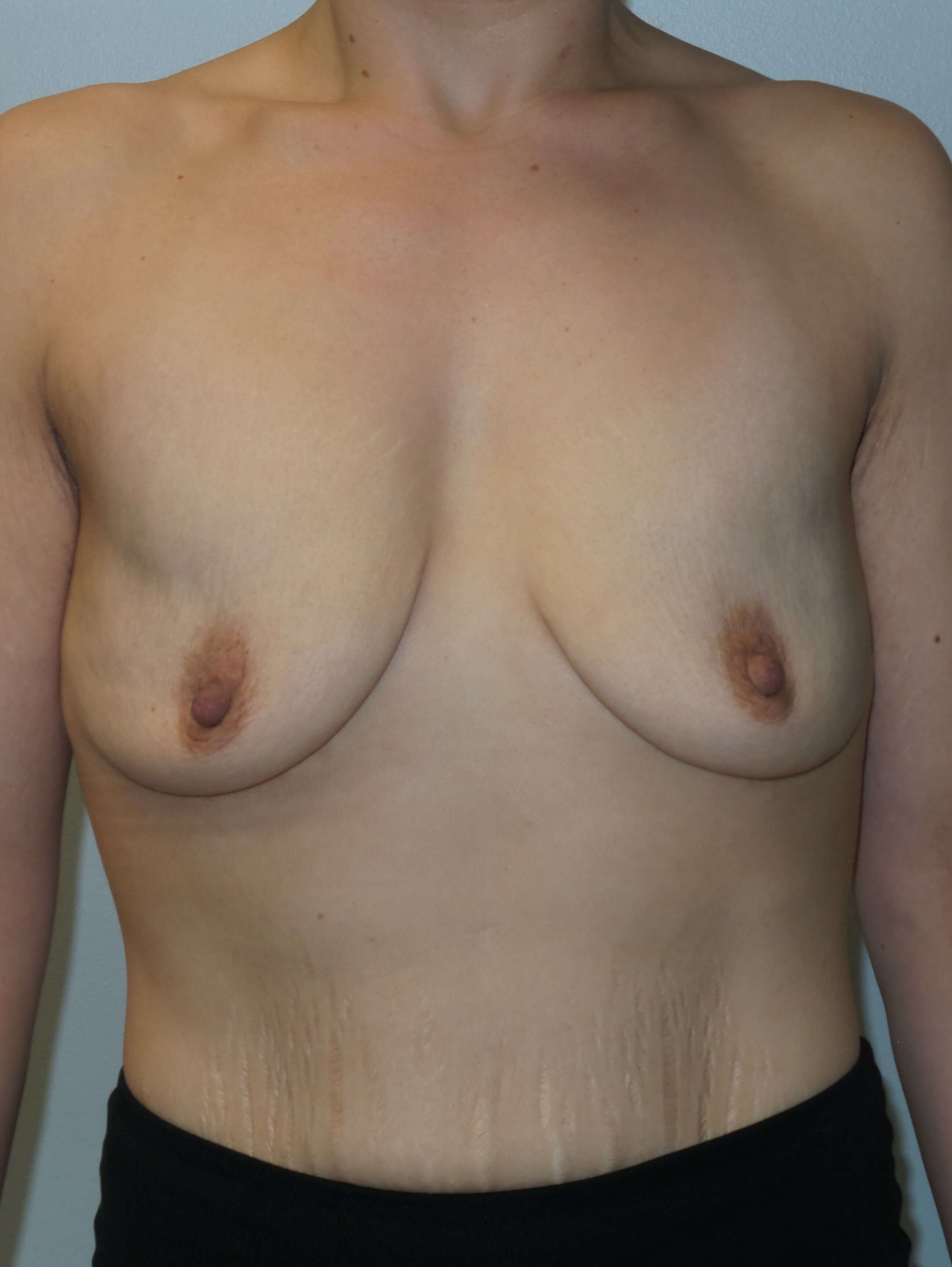 Westlake Woman Has Breast Aug Before