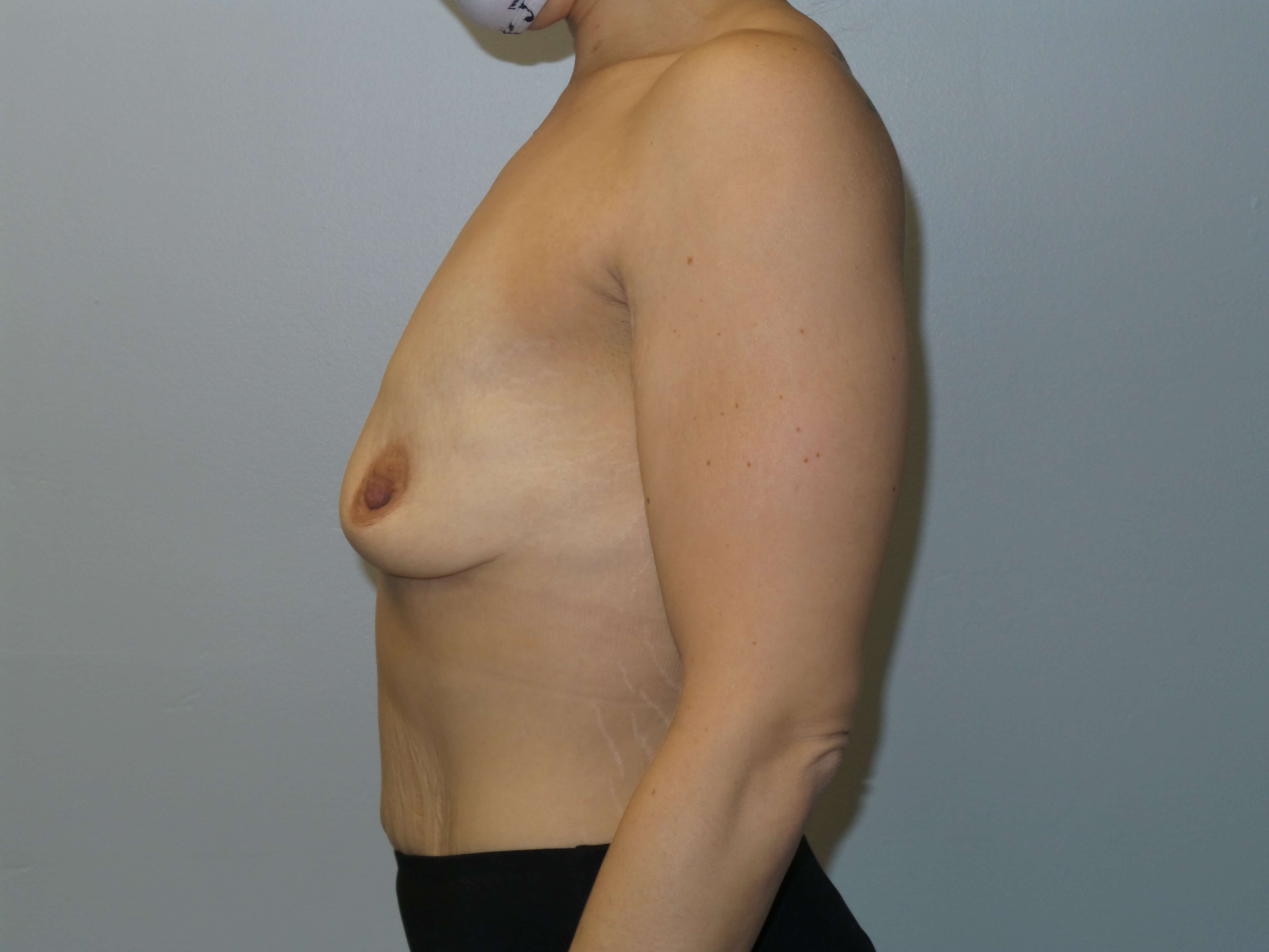 Westlake Woman Has Breast Aug Before