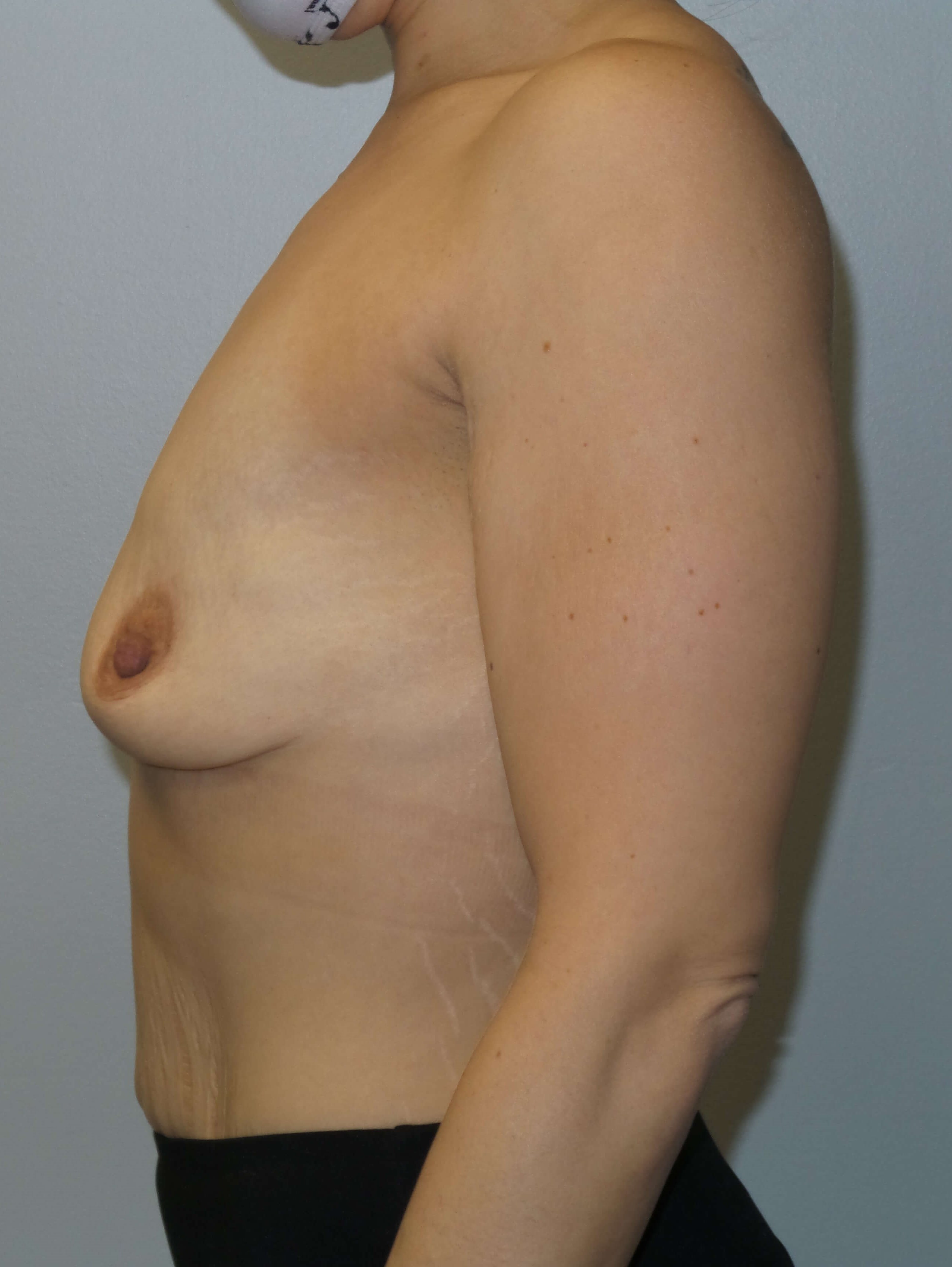 Westlake Woman Has Breast Aug Before