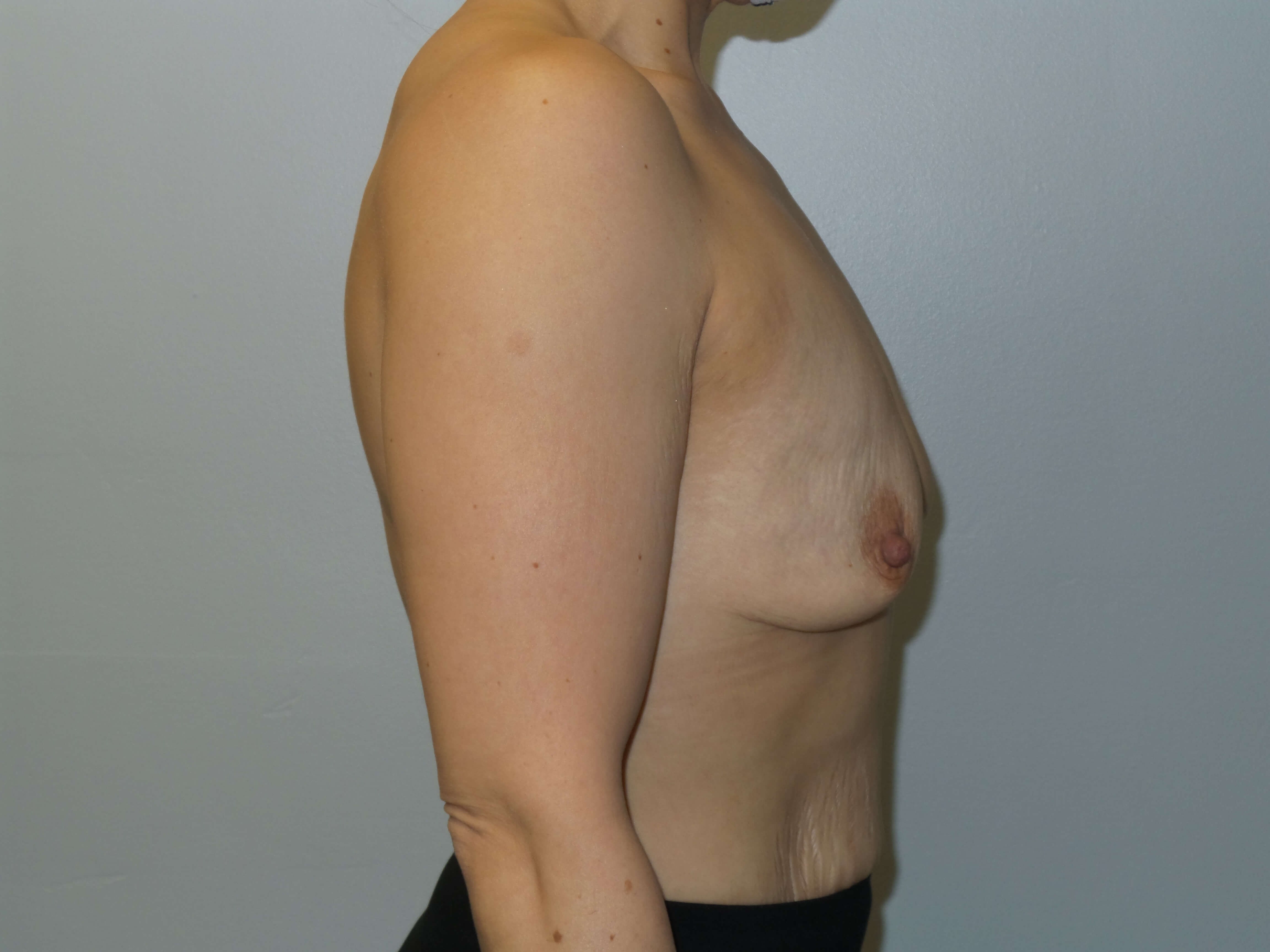 Westlake Woman Has Breast Aug Before