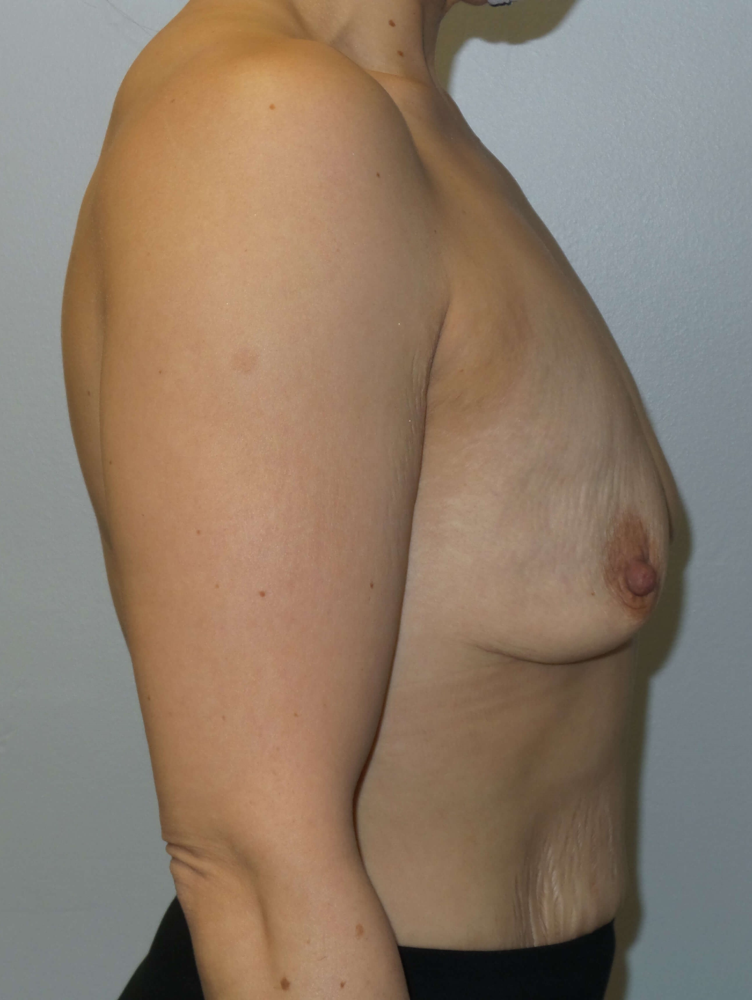 Westlake Woman Has Breast Aug Before