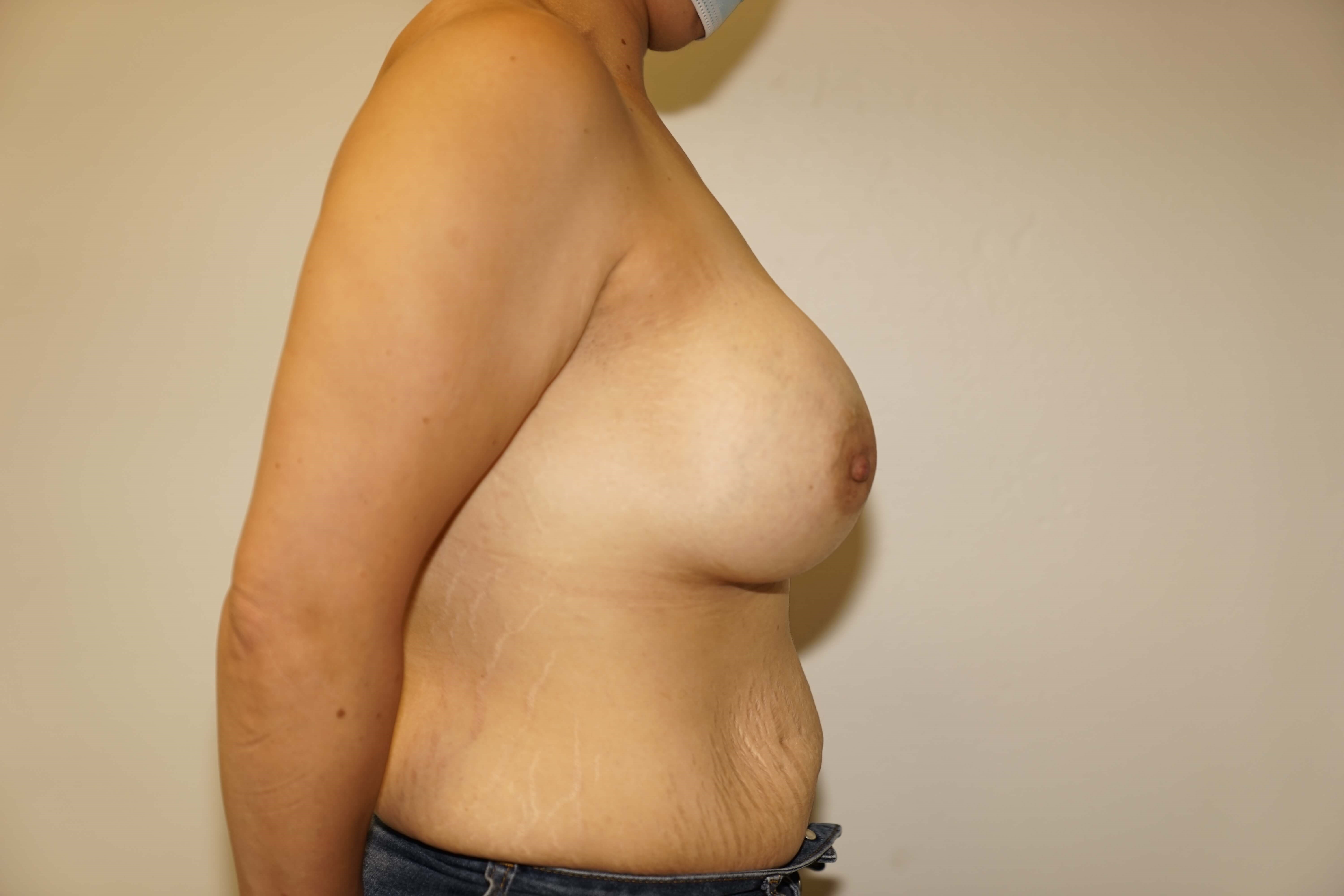 Westlake Woman Has Breast Aug After