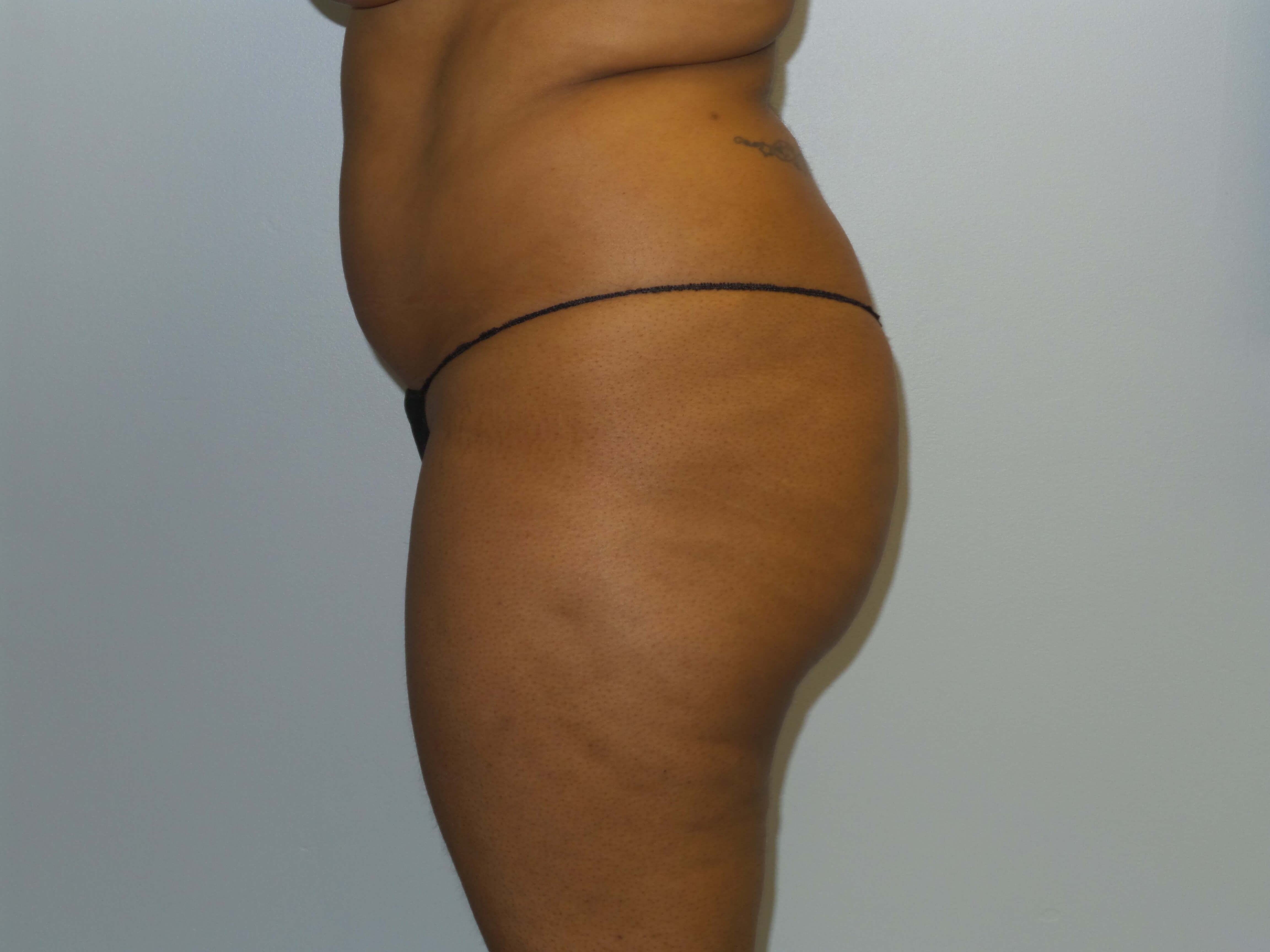Woman has BBL Butt Lift Before