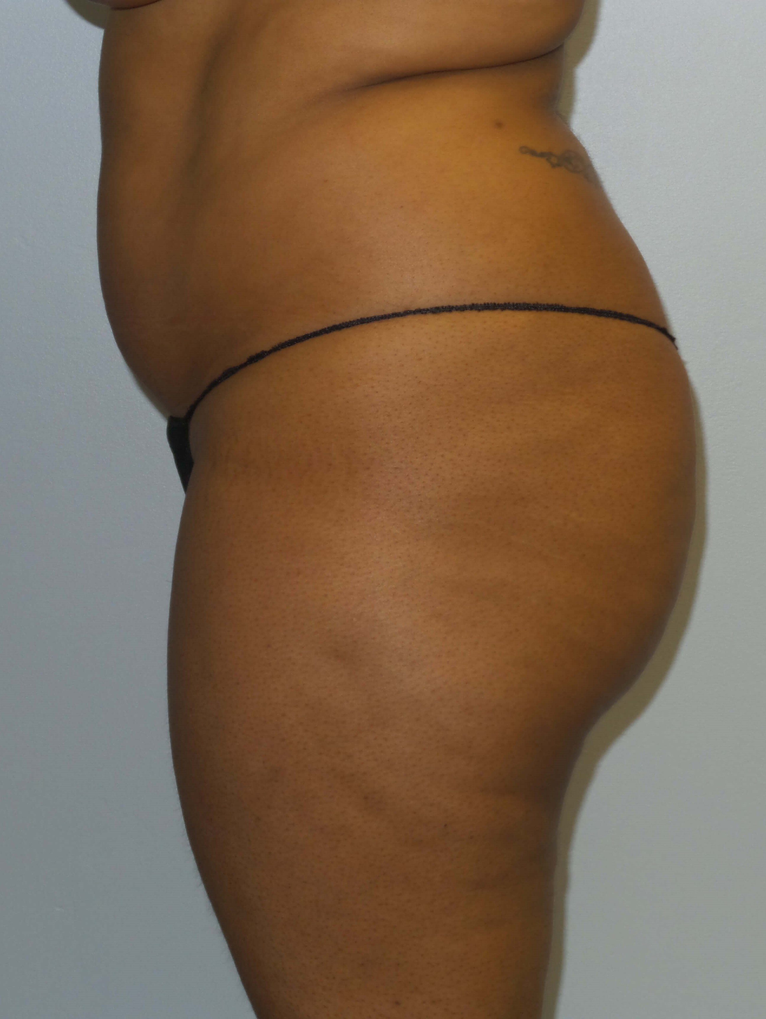 Woman has BBL Butt Lift Before