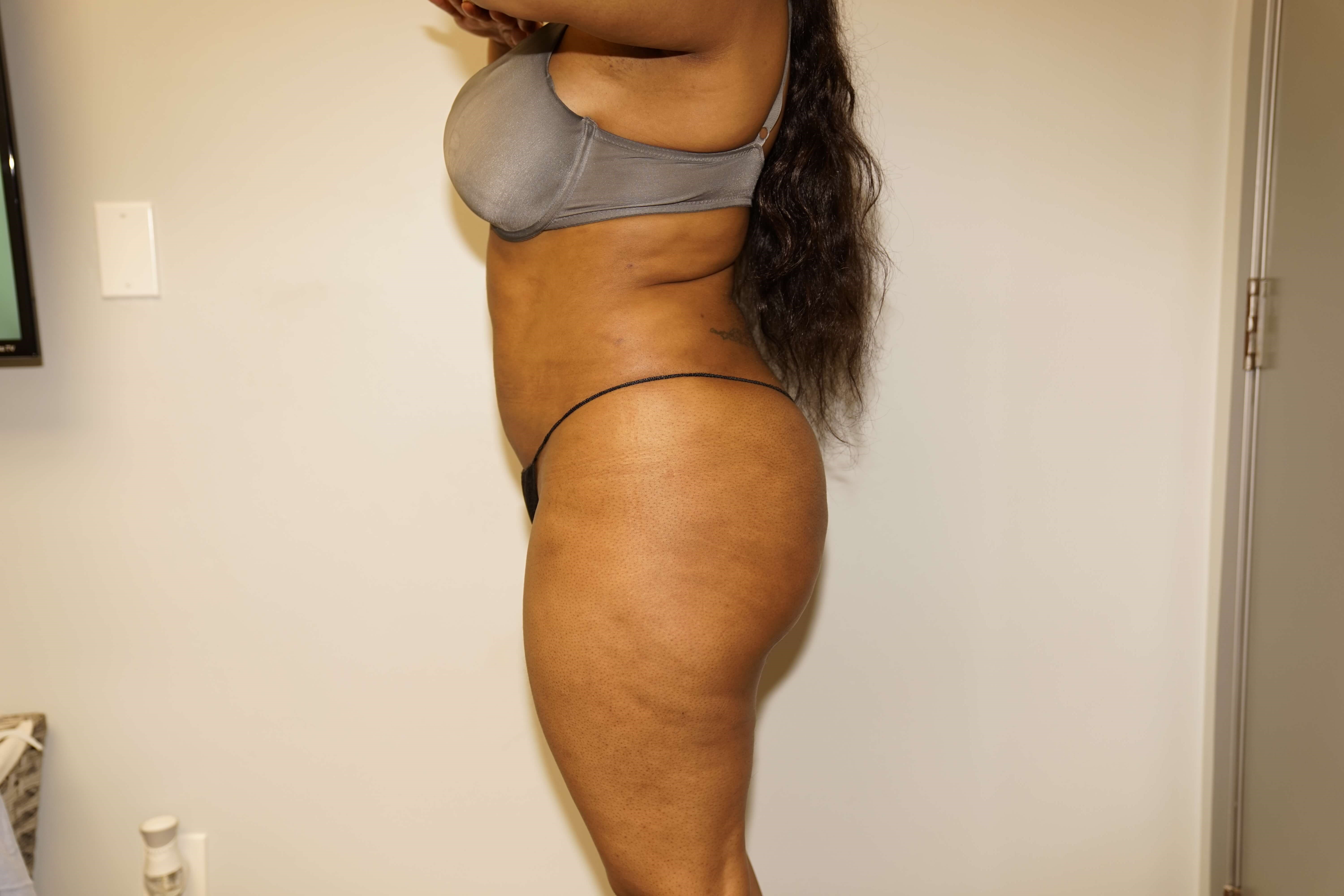 Woman has BBL Butt Lift After