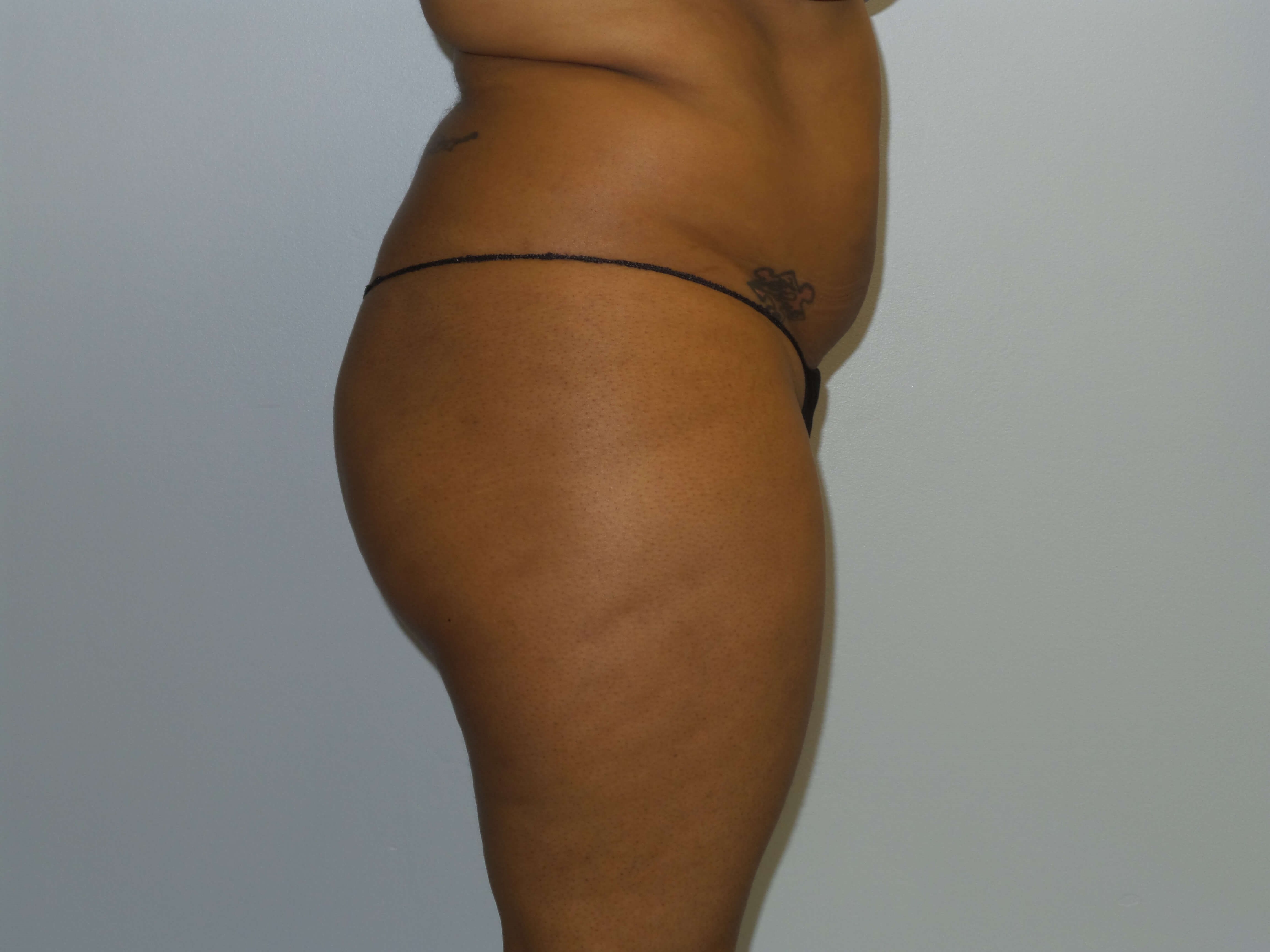 Woman has BBL Butt Lift Before
