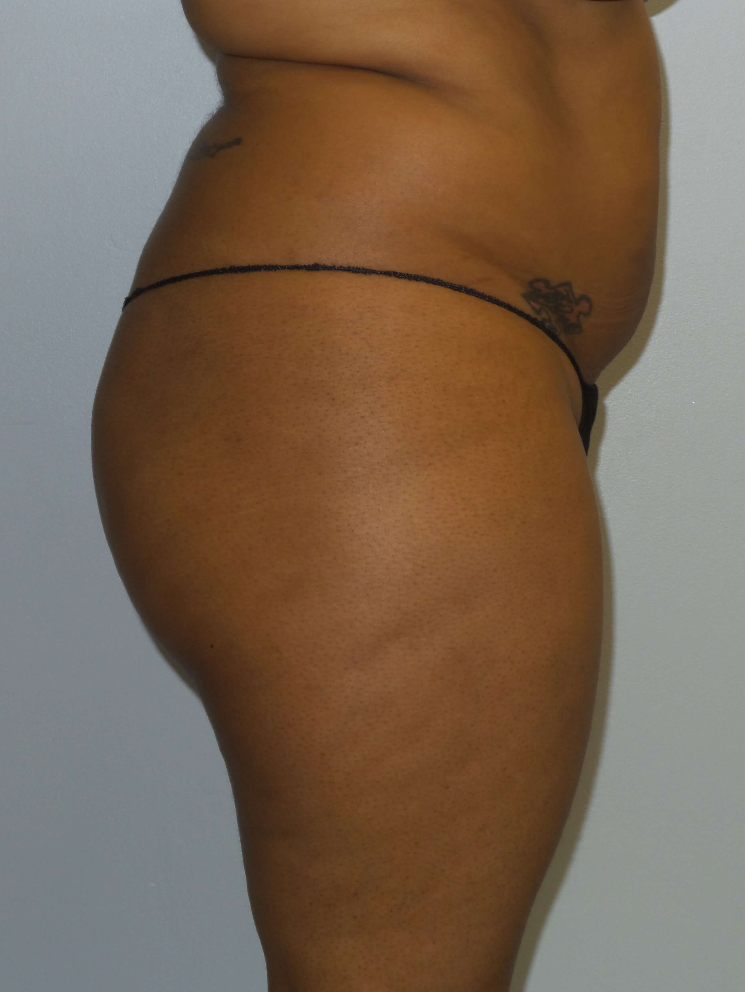 Woman has BBL Butt Lift Before