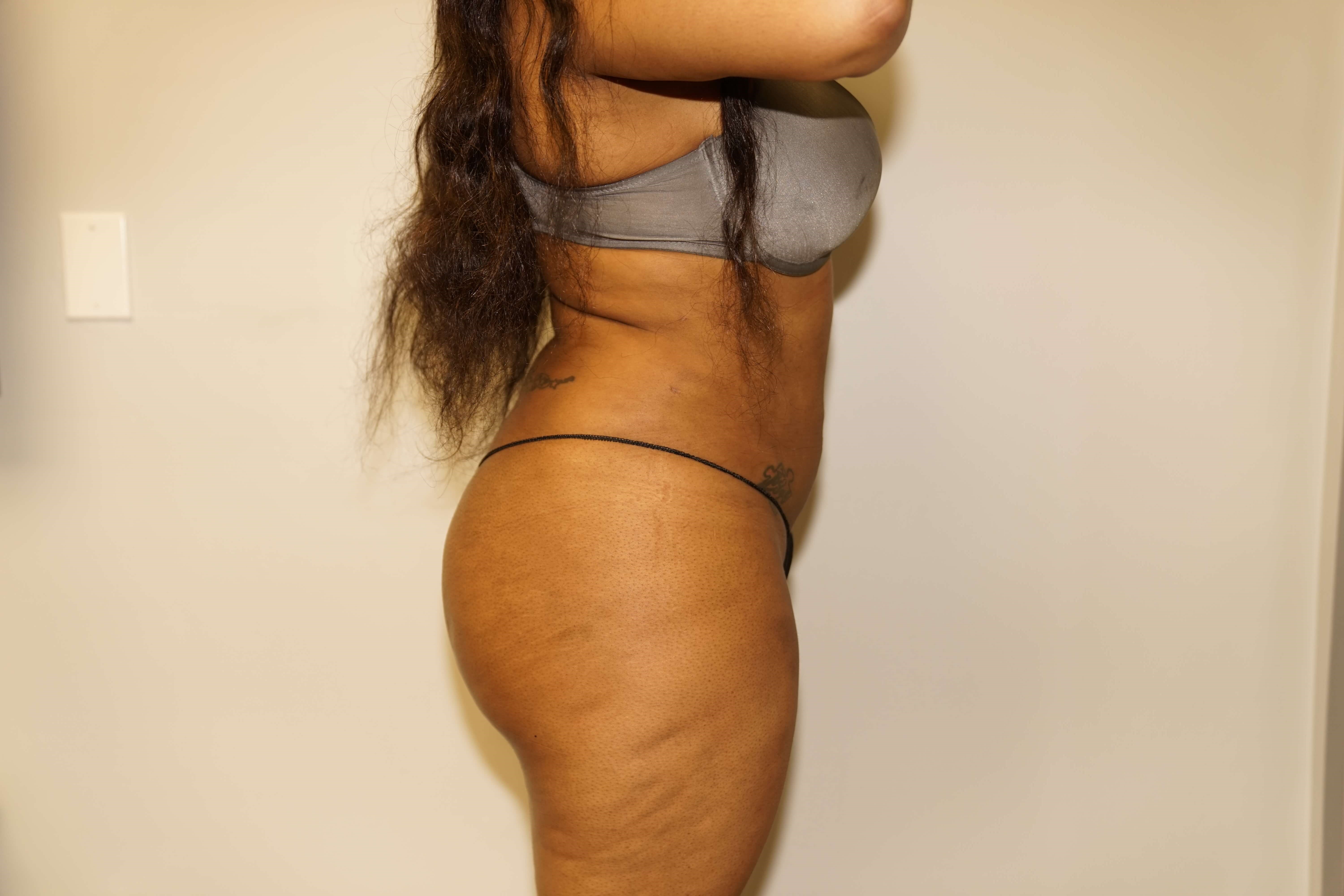 Woman has BBL Butt Lift After