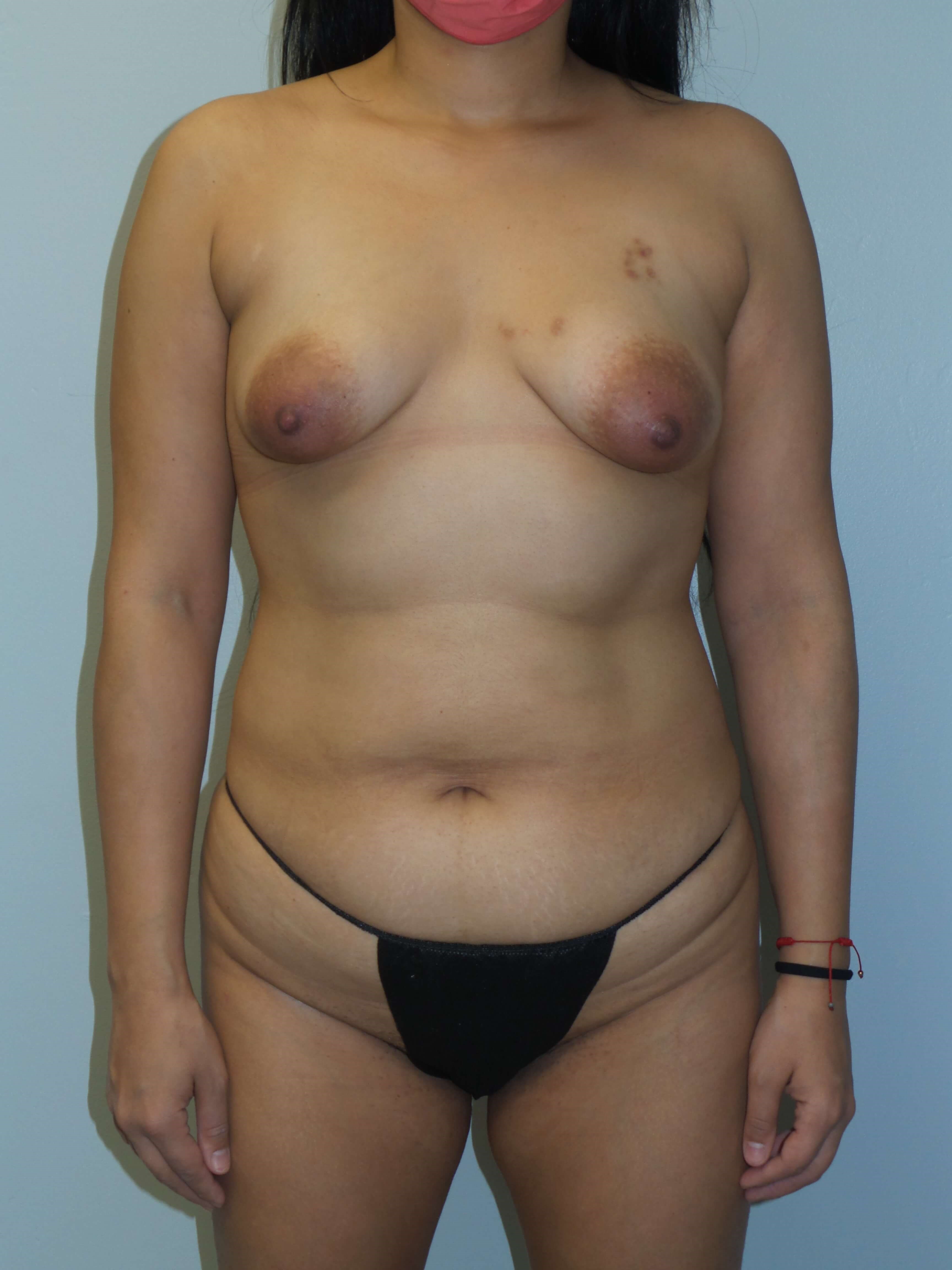 Woman has Mommy Makeover Before