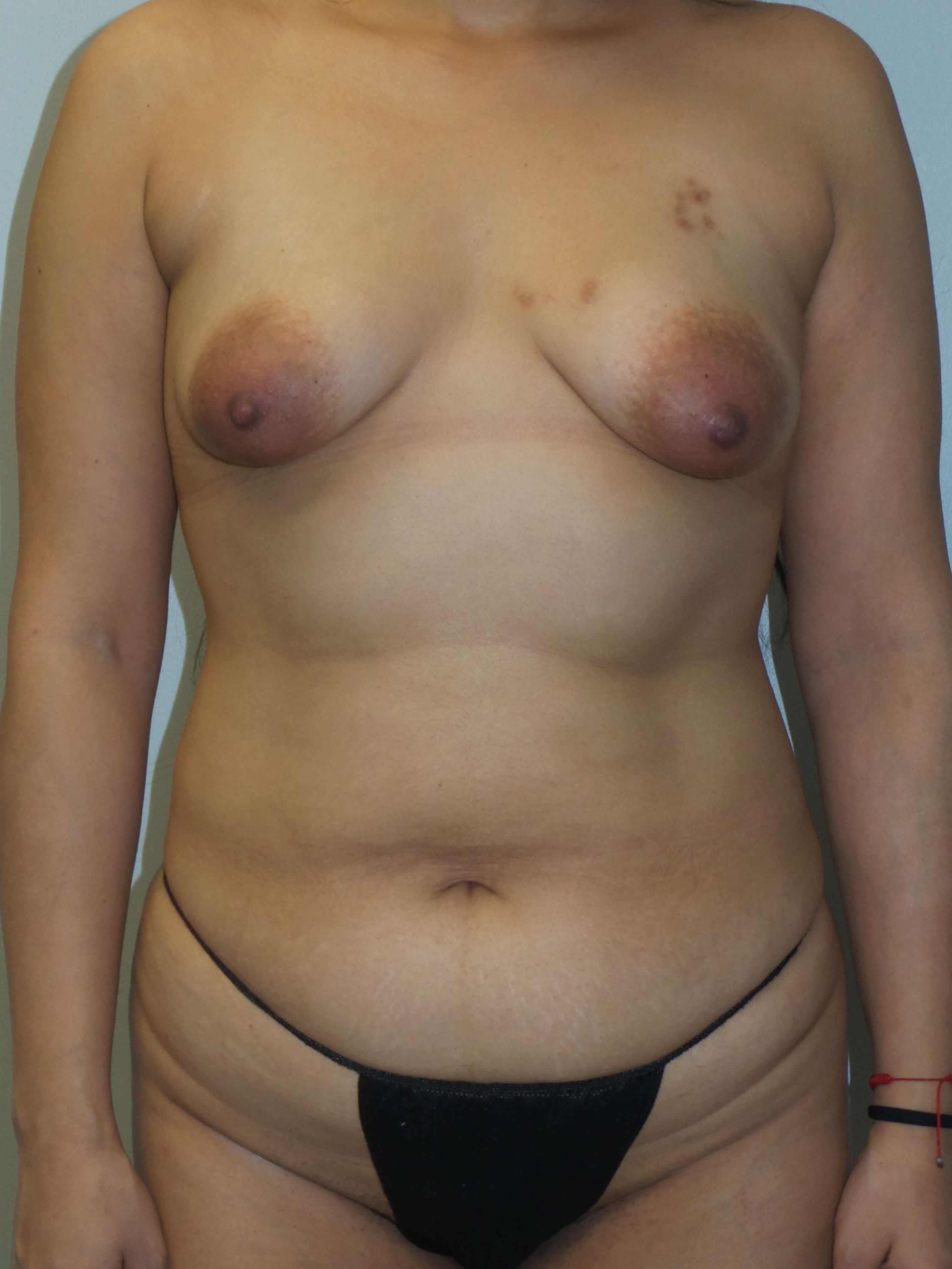 Woman has Mommy Makeover Before