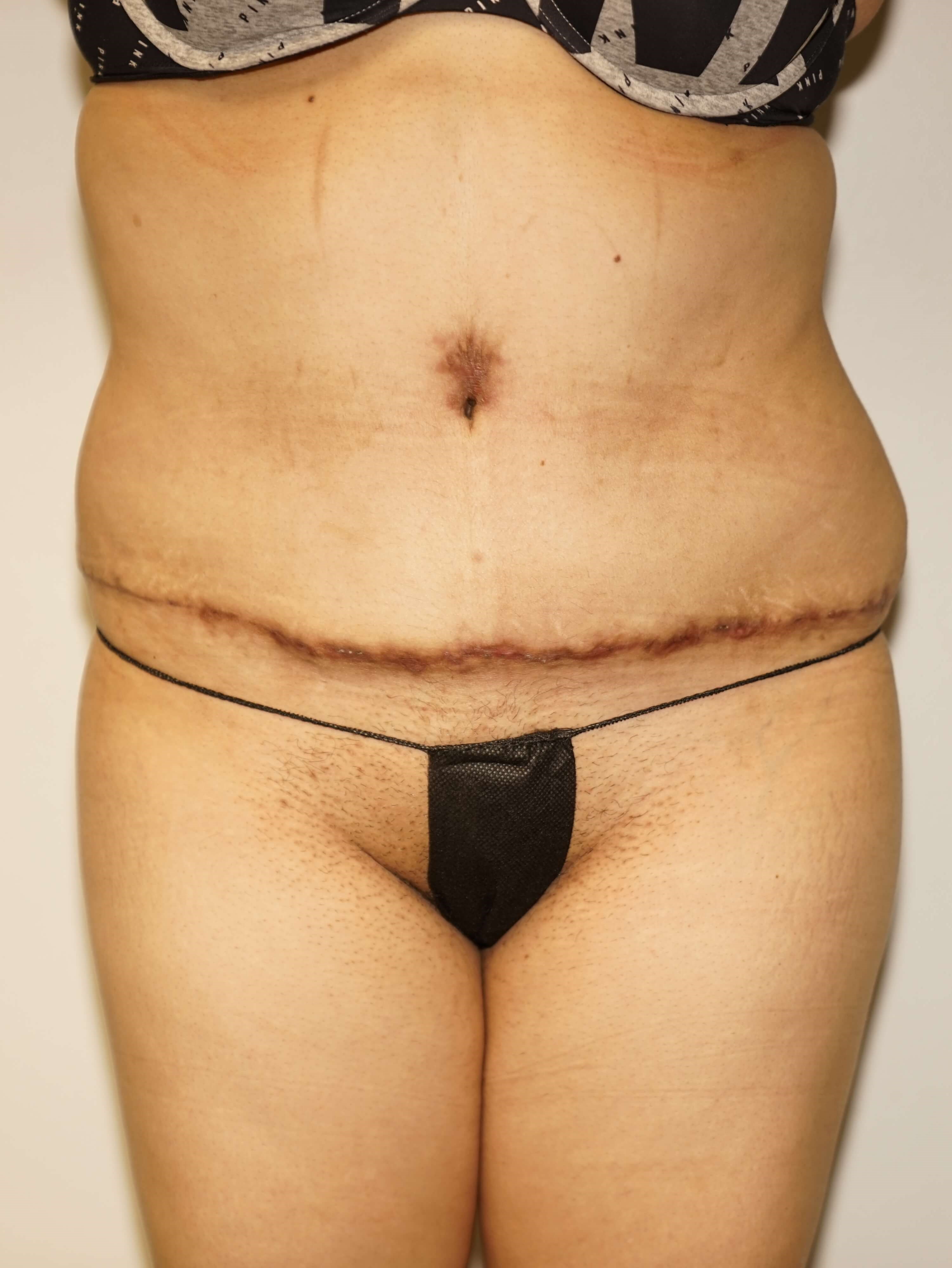 Woman has Tummy Tuck + Lipo After
