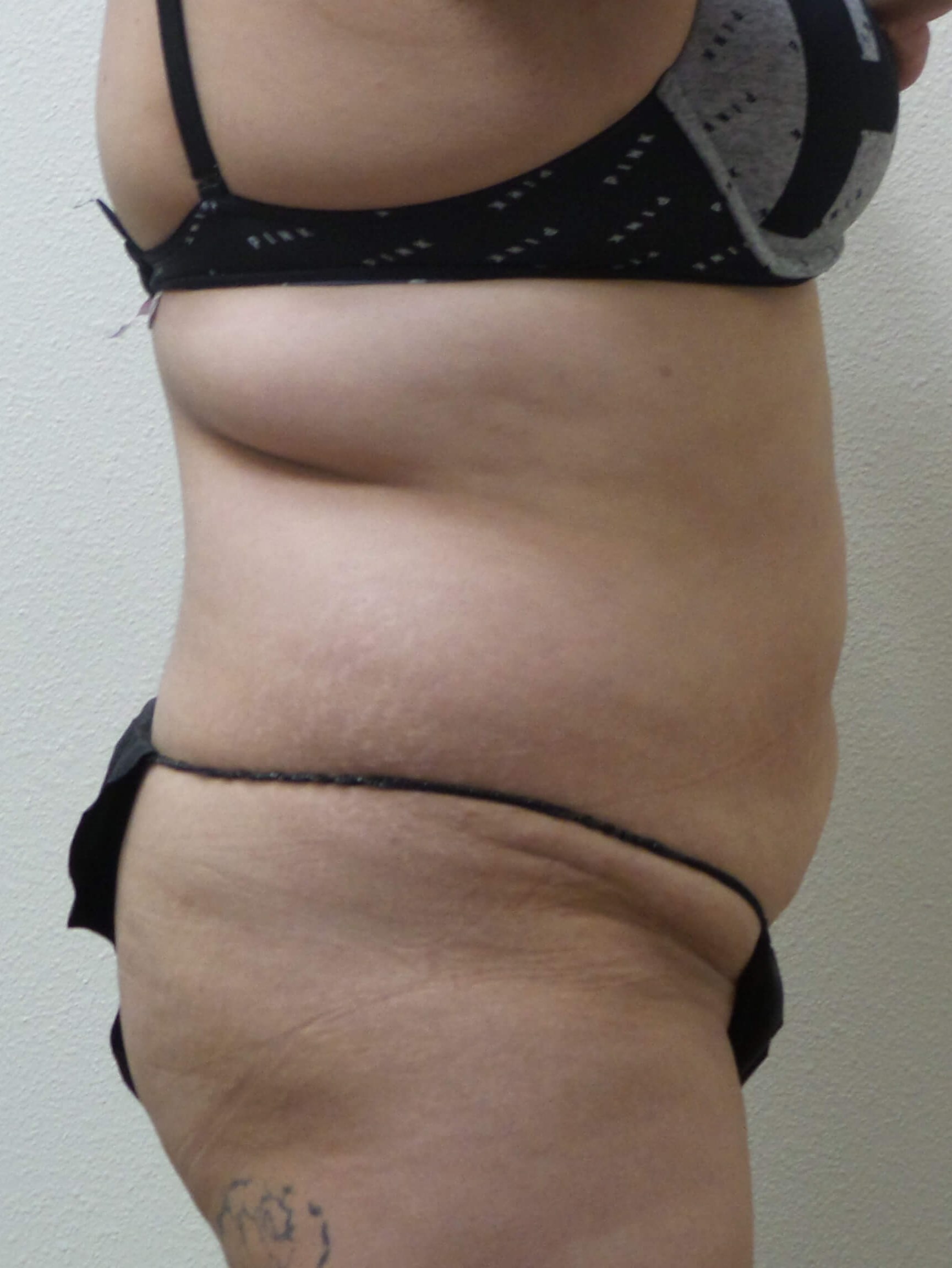 Woman has Tummy Tuck + Lipo Before