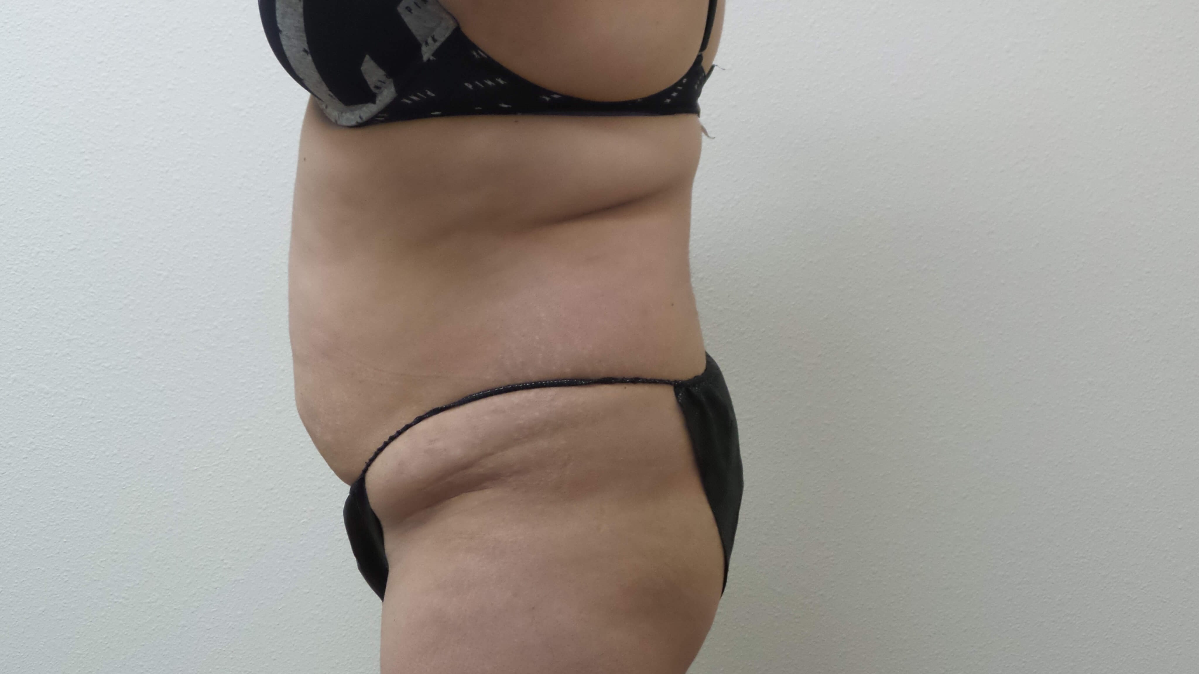 Woman has Tummy Tuck + Lipo Before