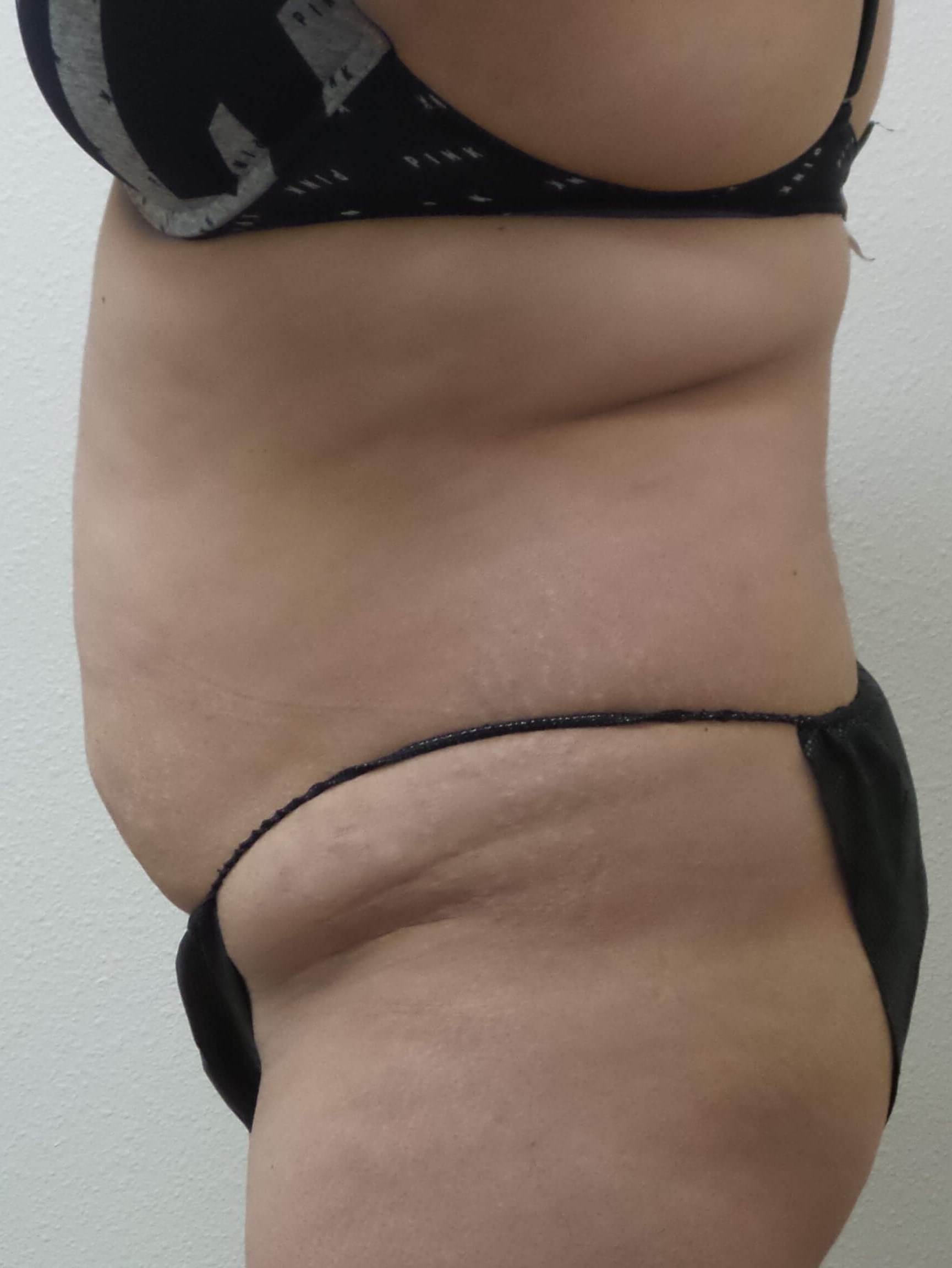 Woman has Tummy Tuck + Lipo Before