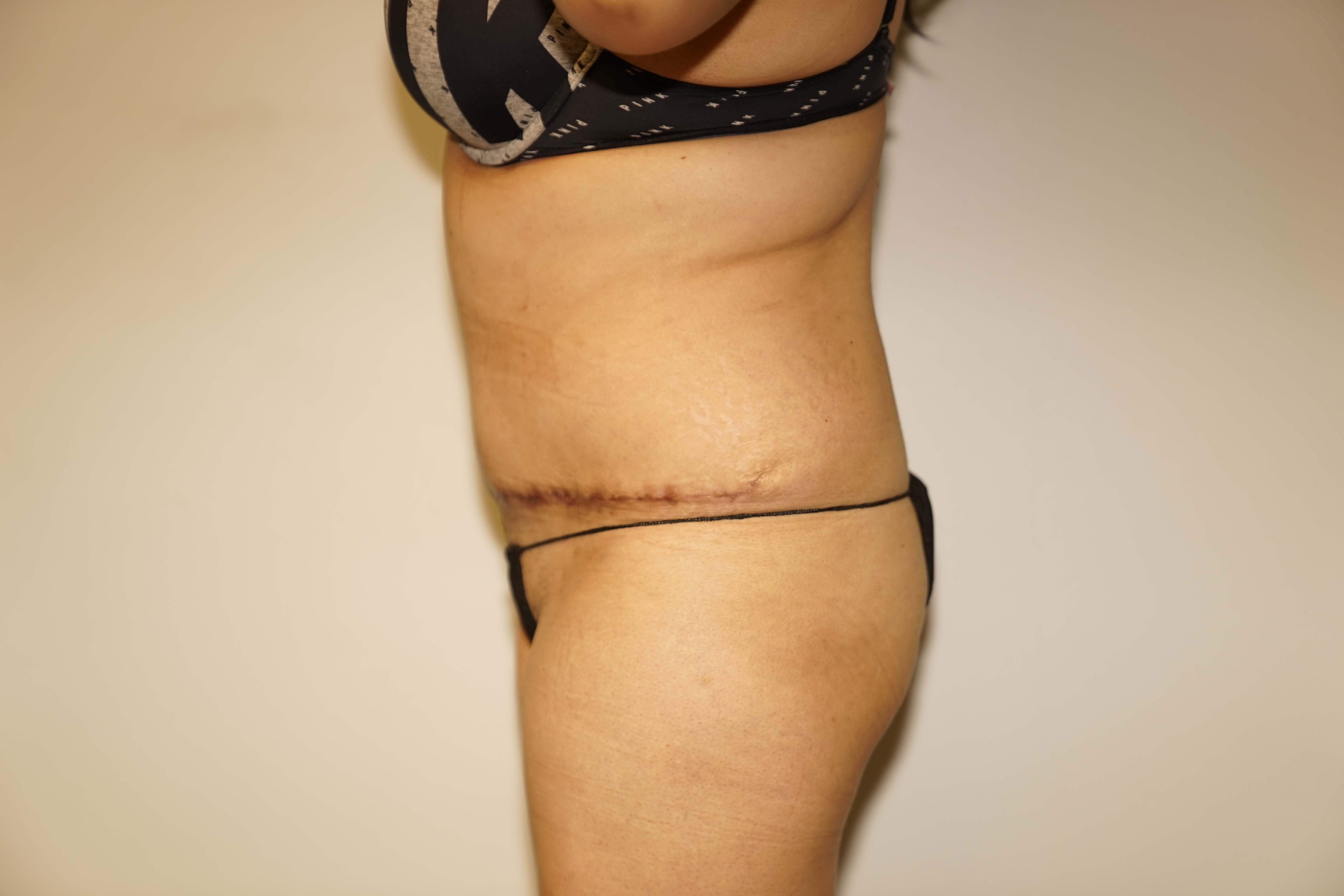Woman has Tummy Tuck + Lipo After