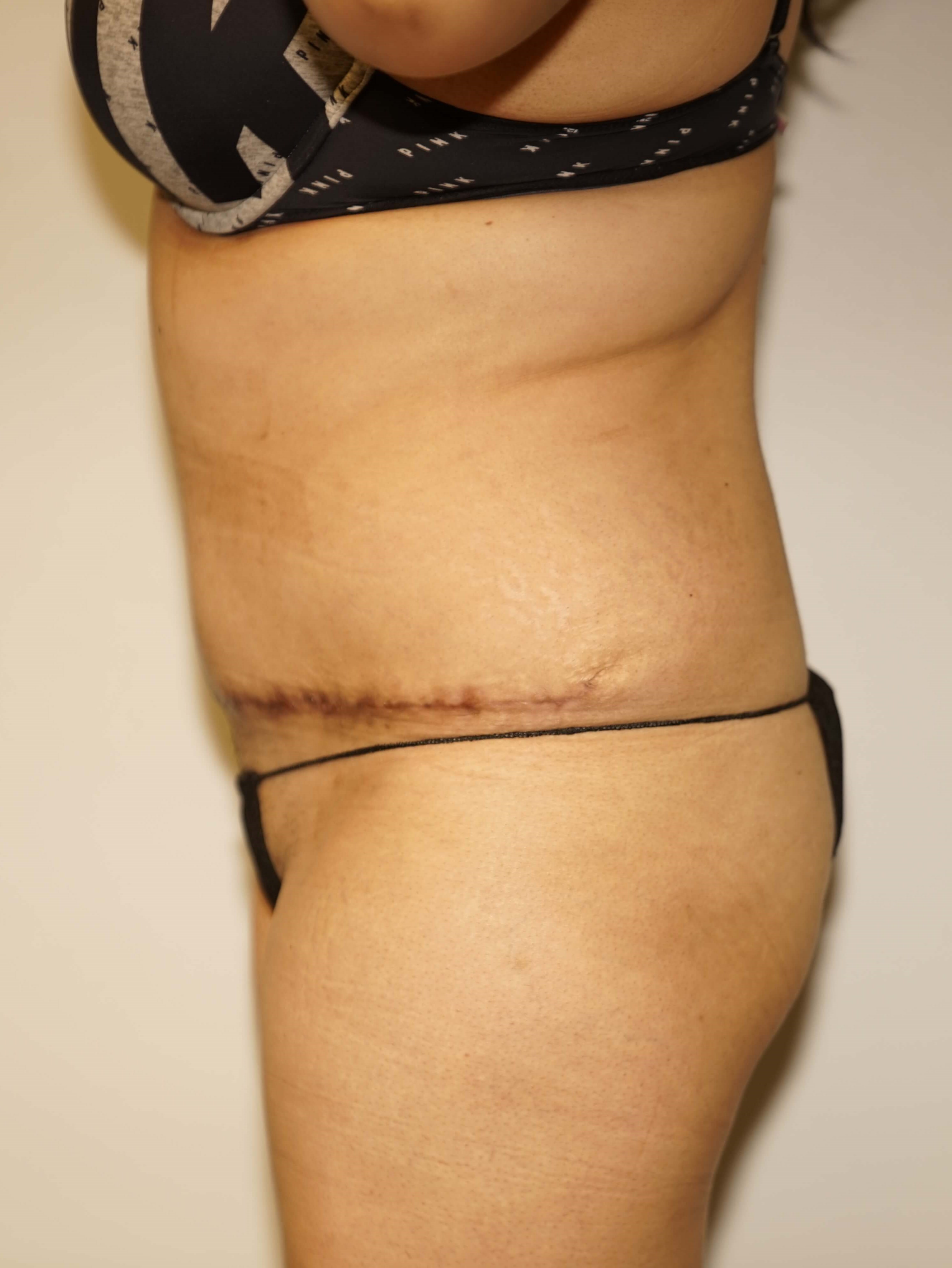 Woman has Tummy Tuck + Lipo After