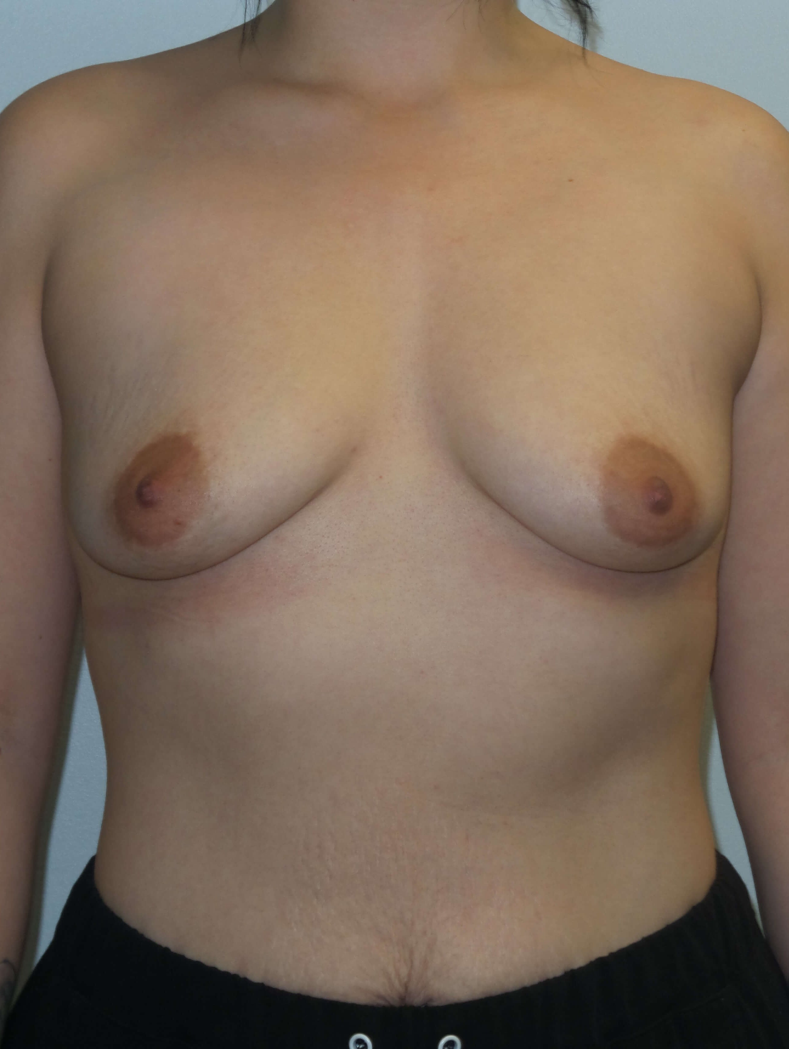 Westlake Woman Has Breast Aug Before