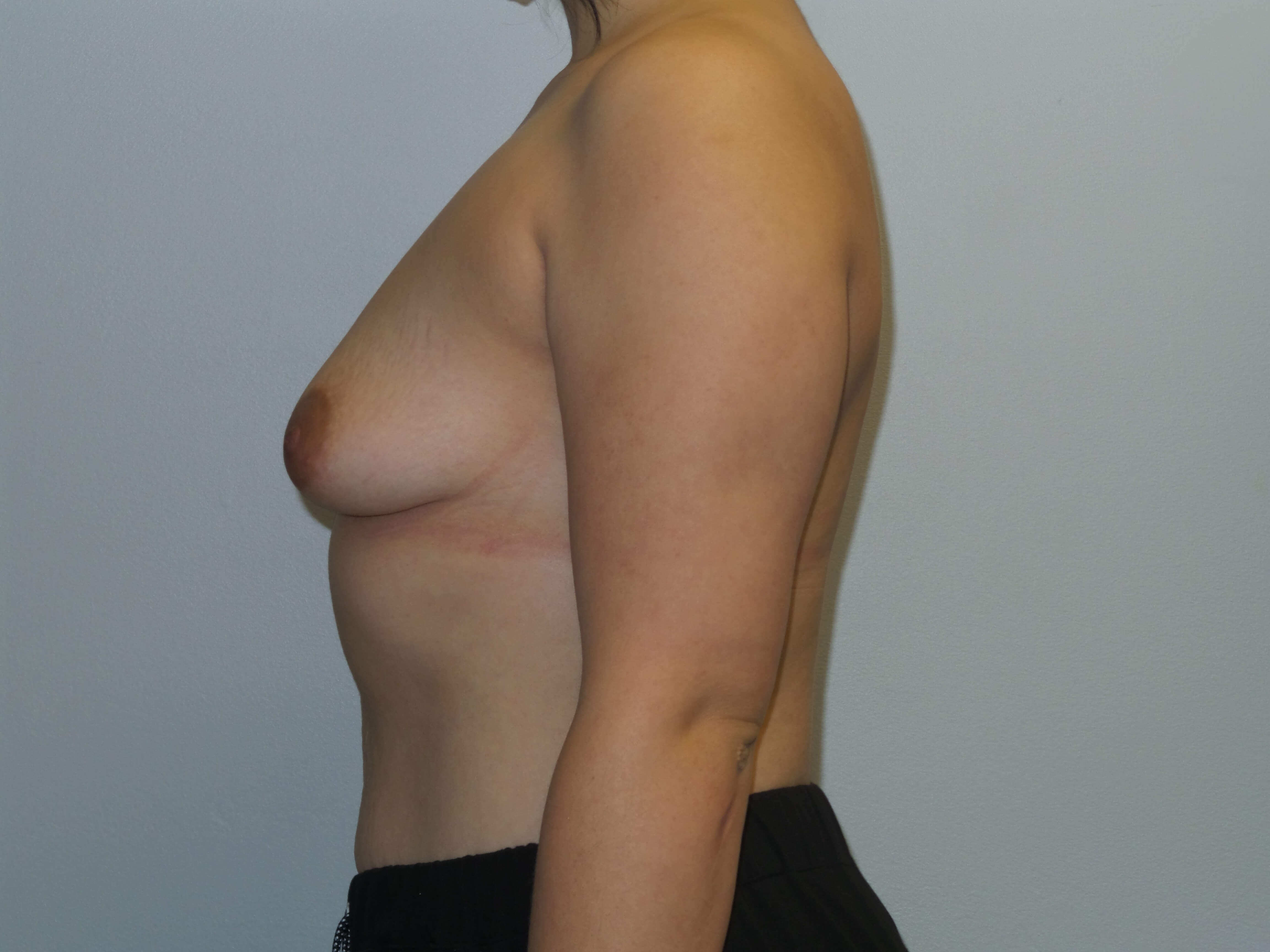 Westlake Woman Has Breast Aug Before