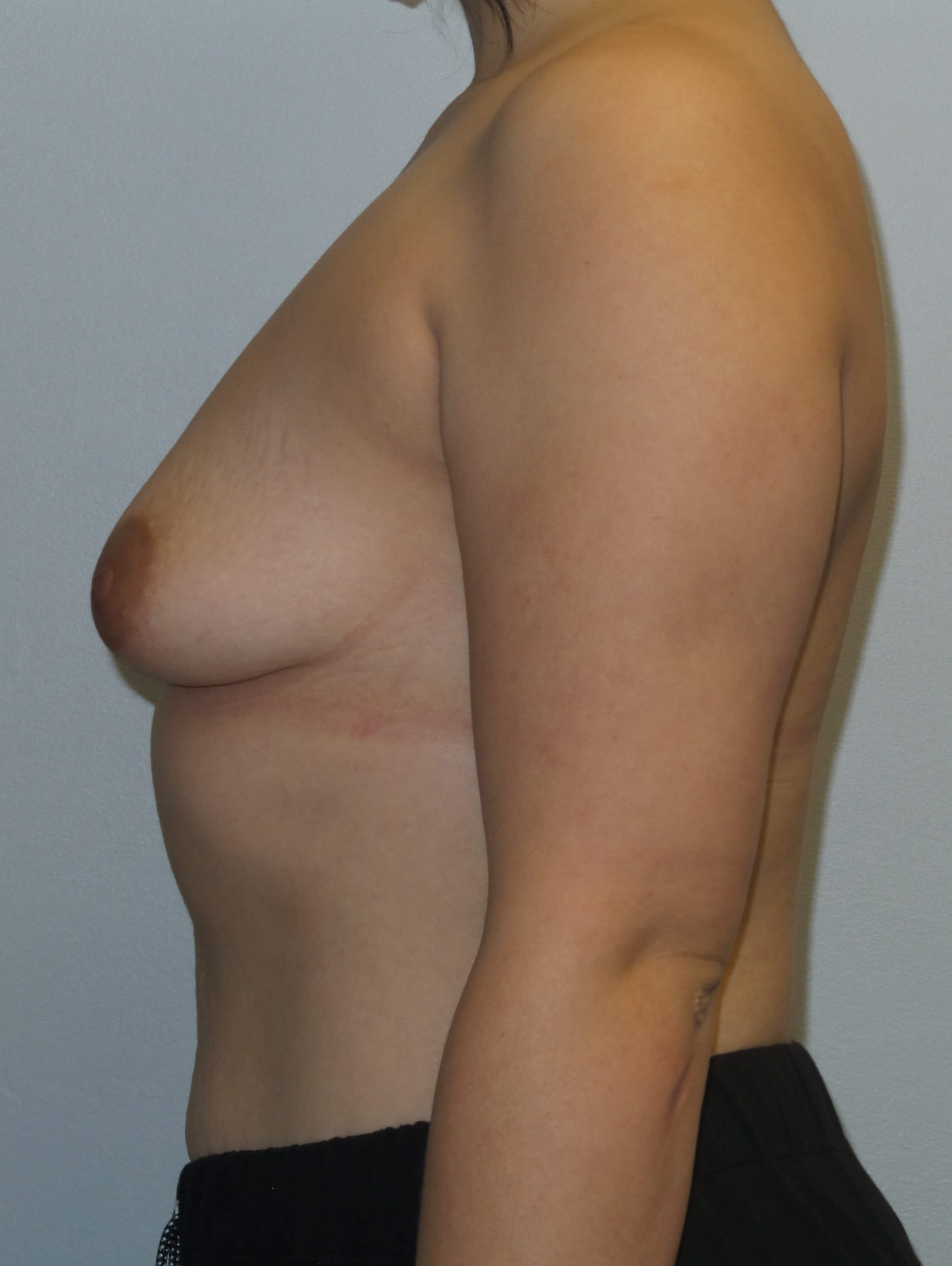 Westlake Woman Has Breast Aug Before