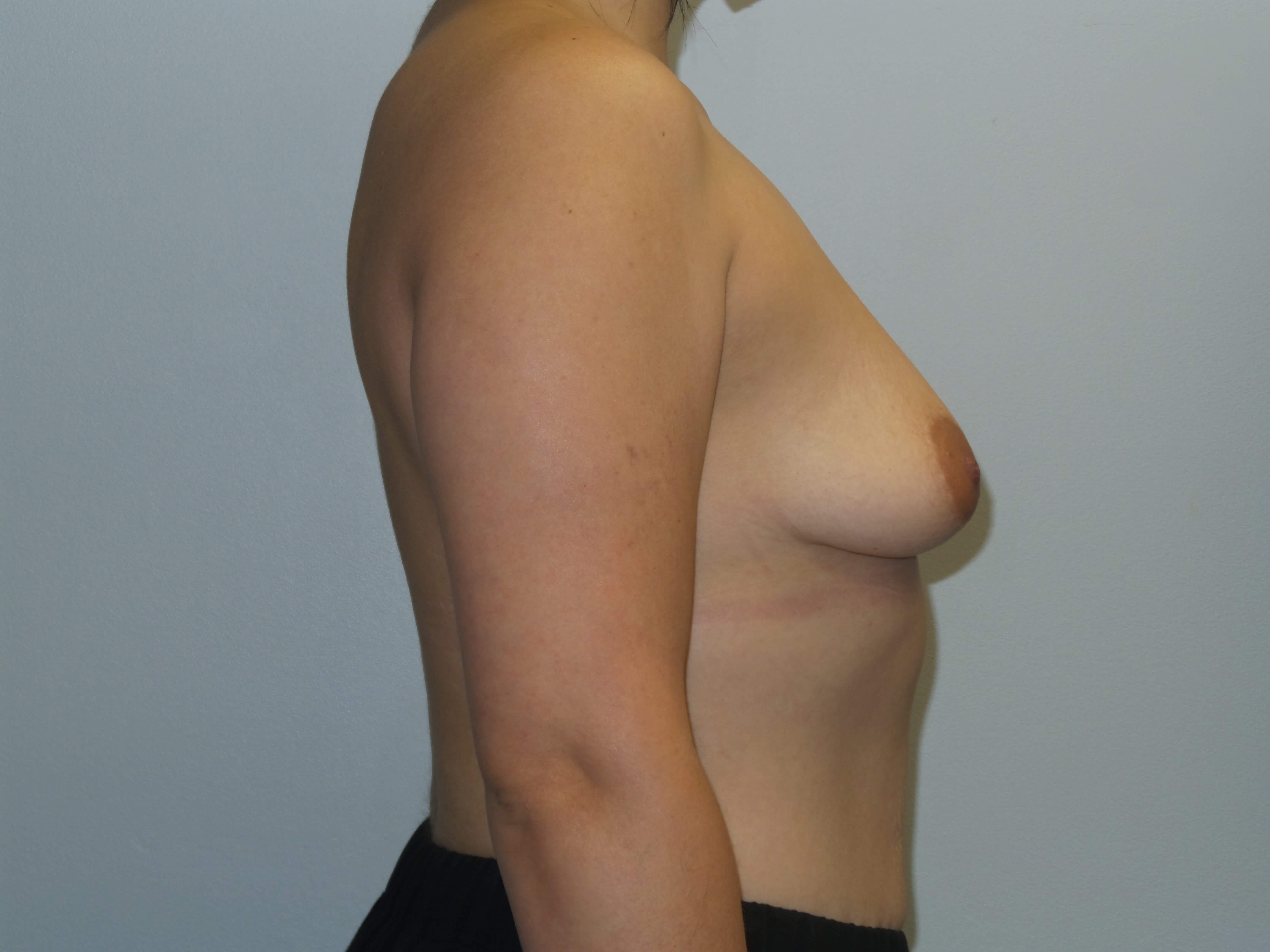 Westlake Woman Has Breast Aug Before