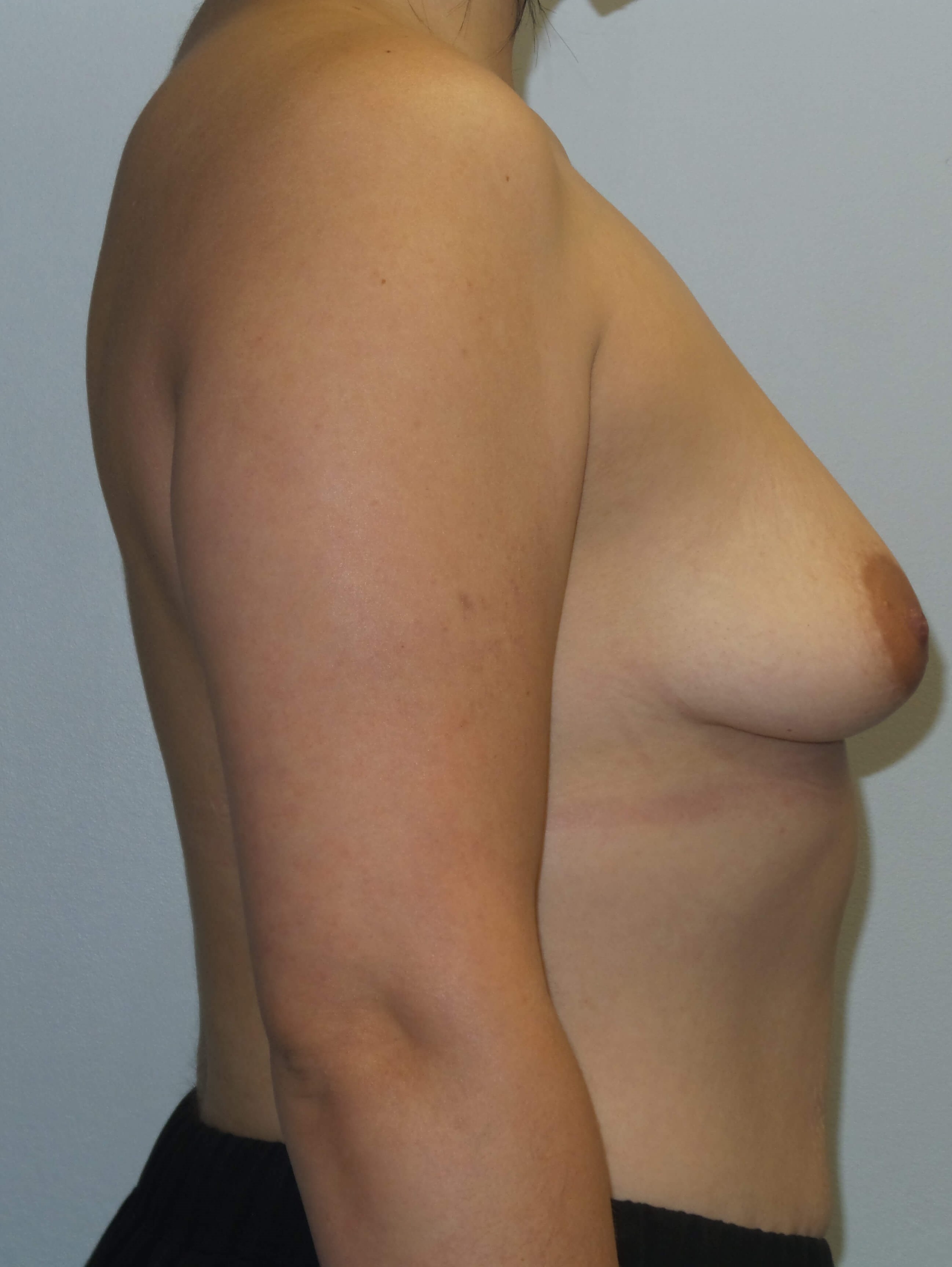 Westlake Woman Has Breast Aug Before