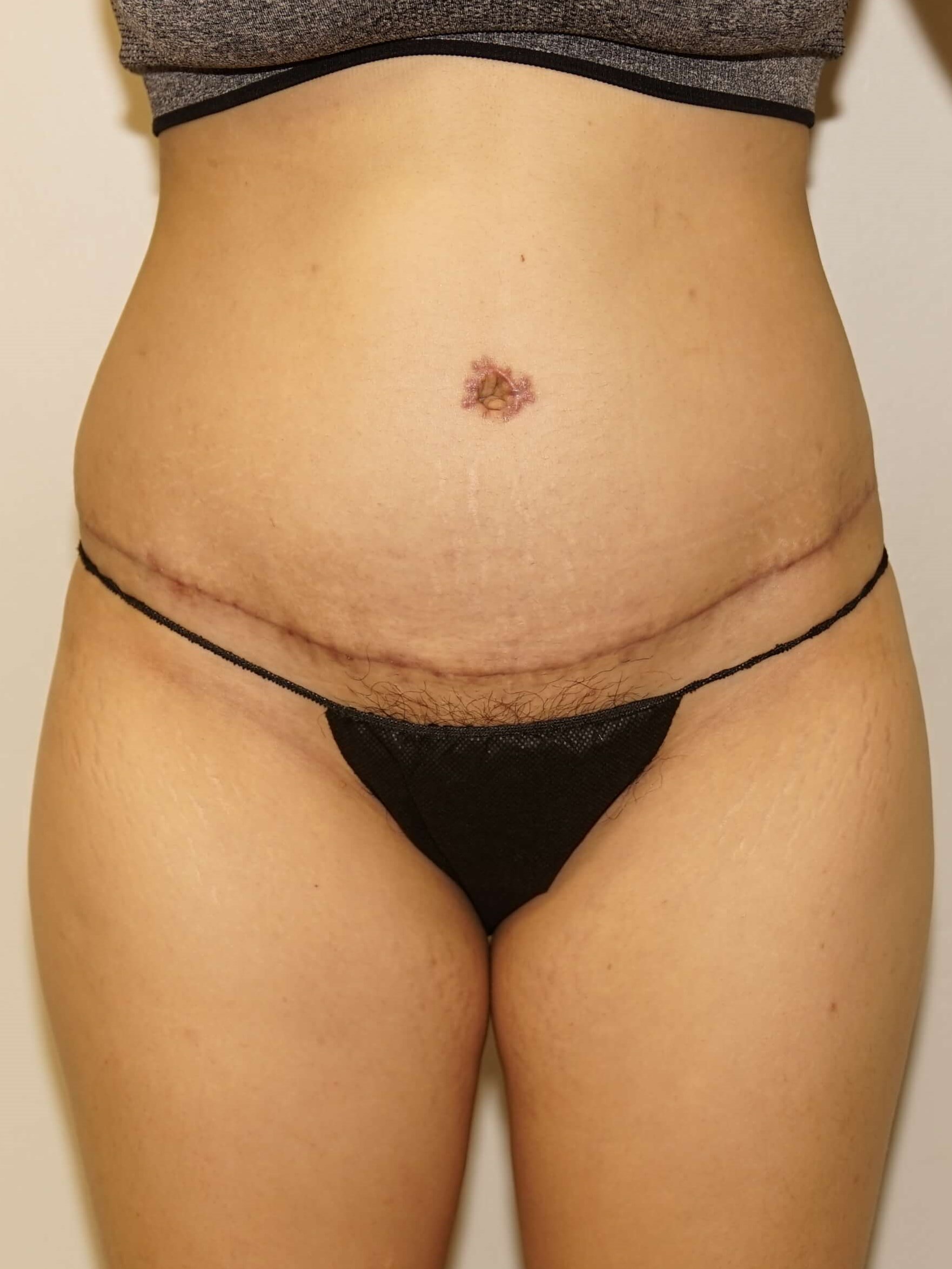 Woman Has Tummy Tuck Lipo After