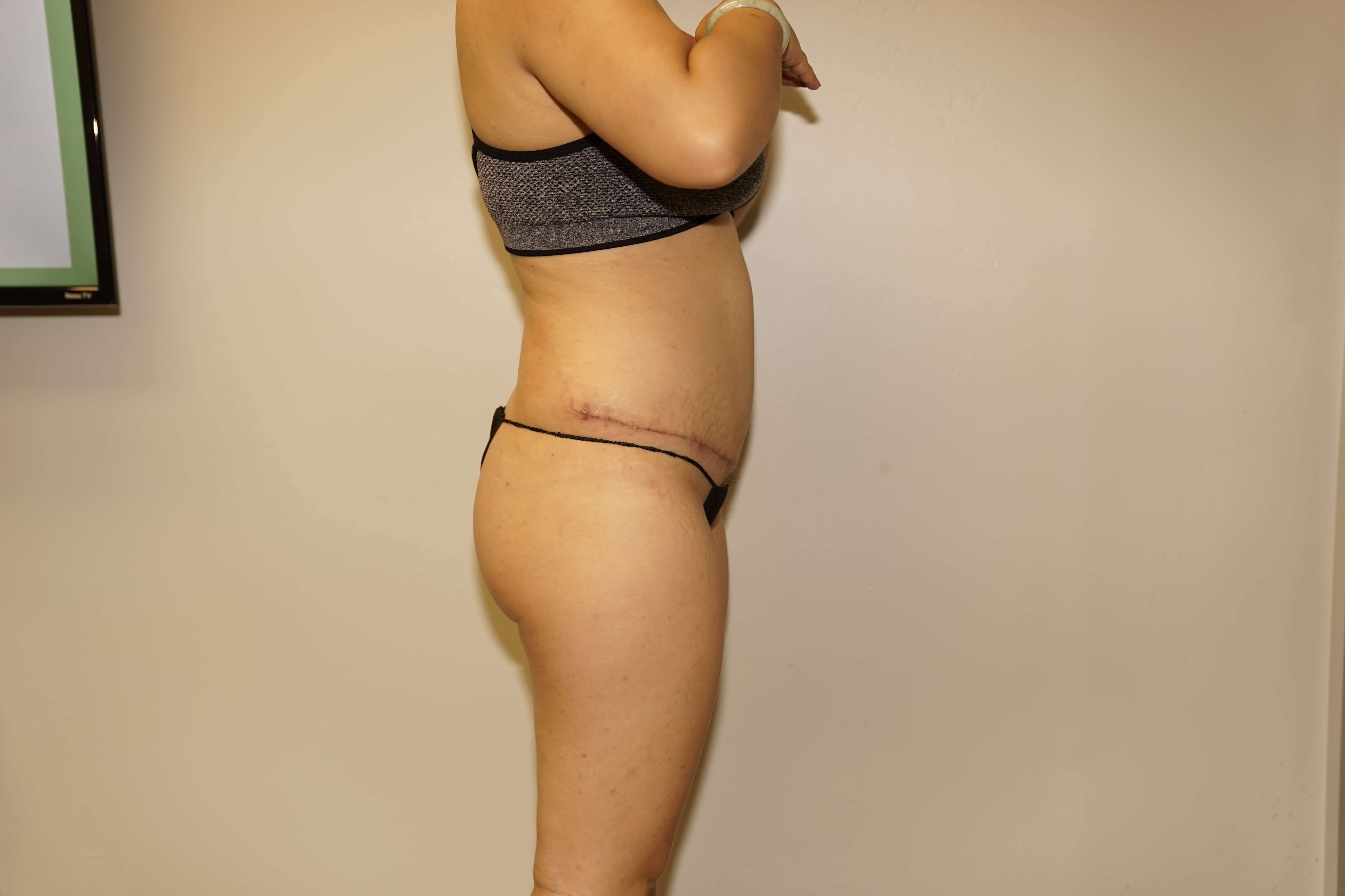 Woman Has Tummy Tuck Lipo After