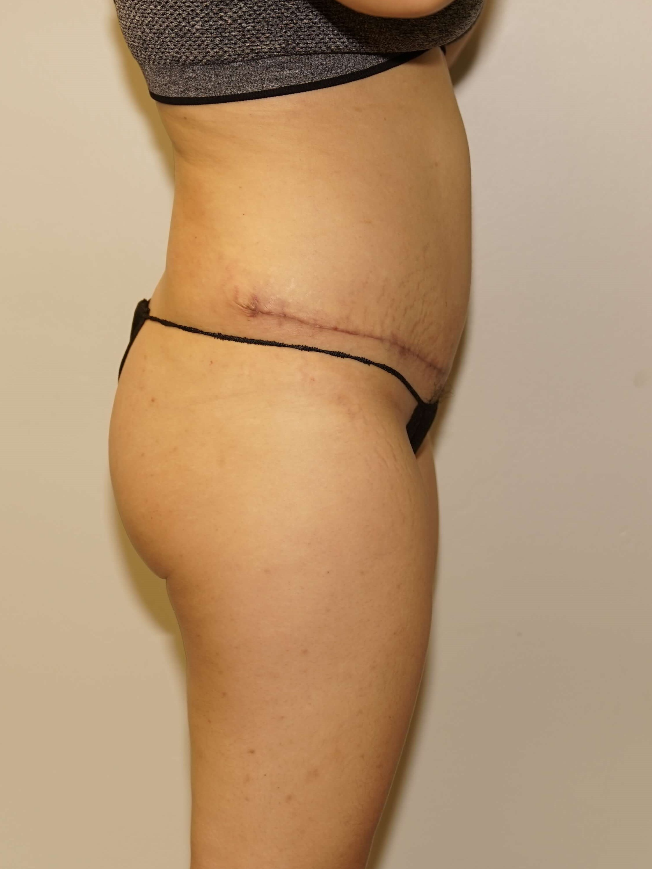 Woman Has Tummy Tuck Lipo After