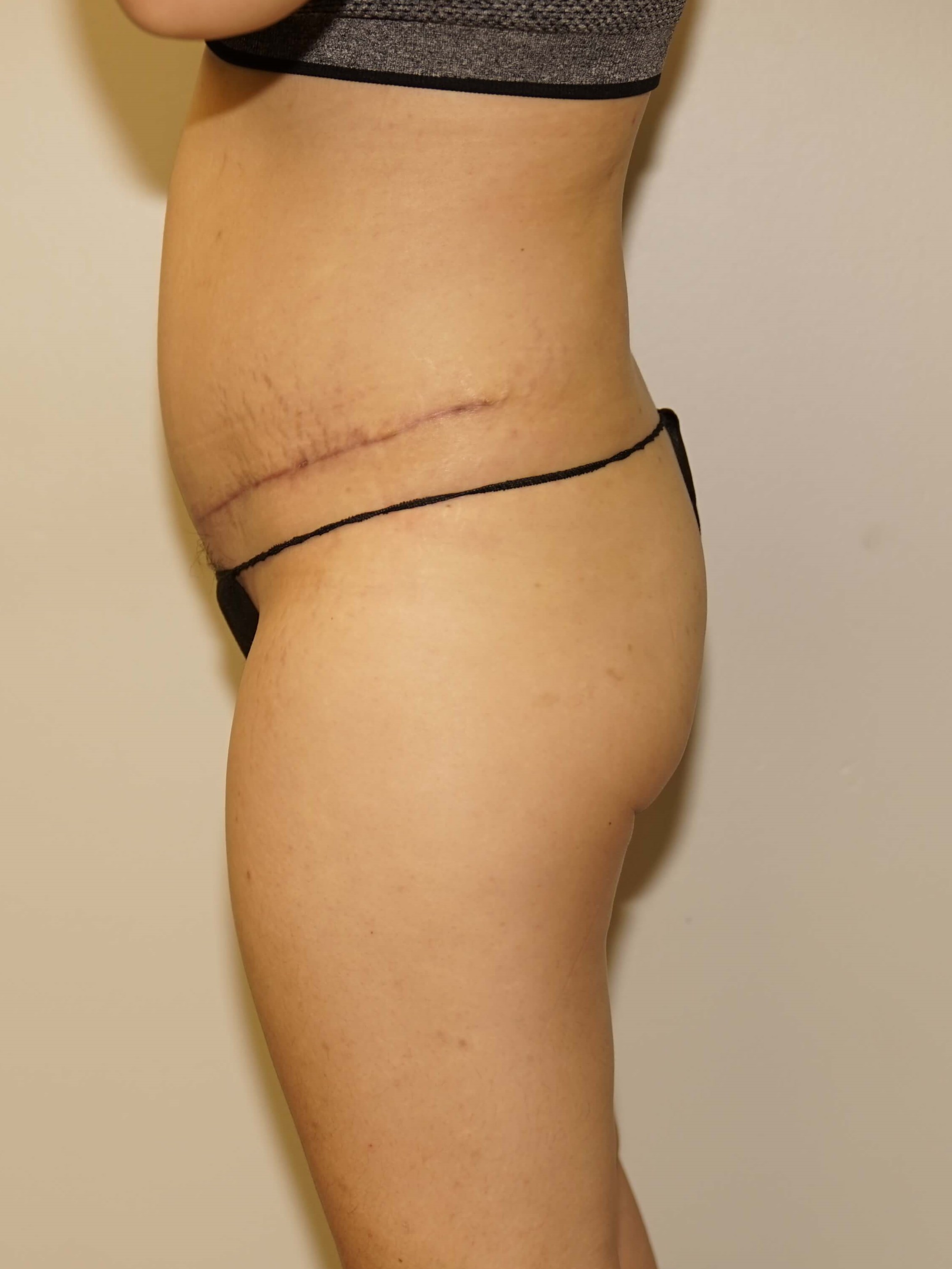 Woman Has Tummy Tuck Lipo After