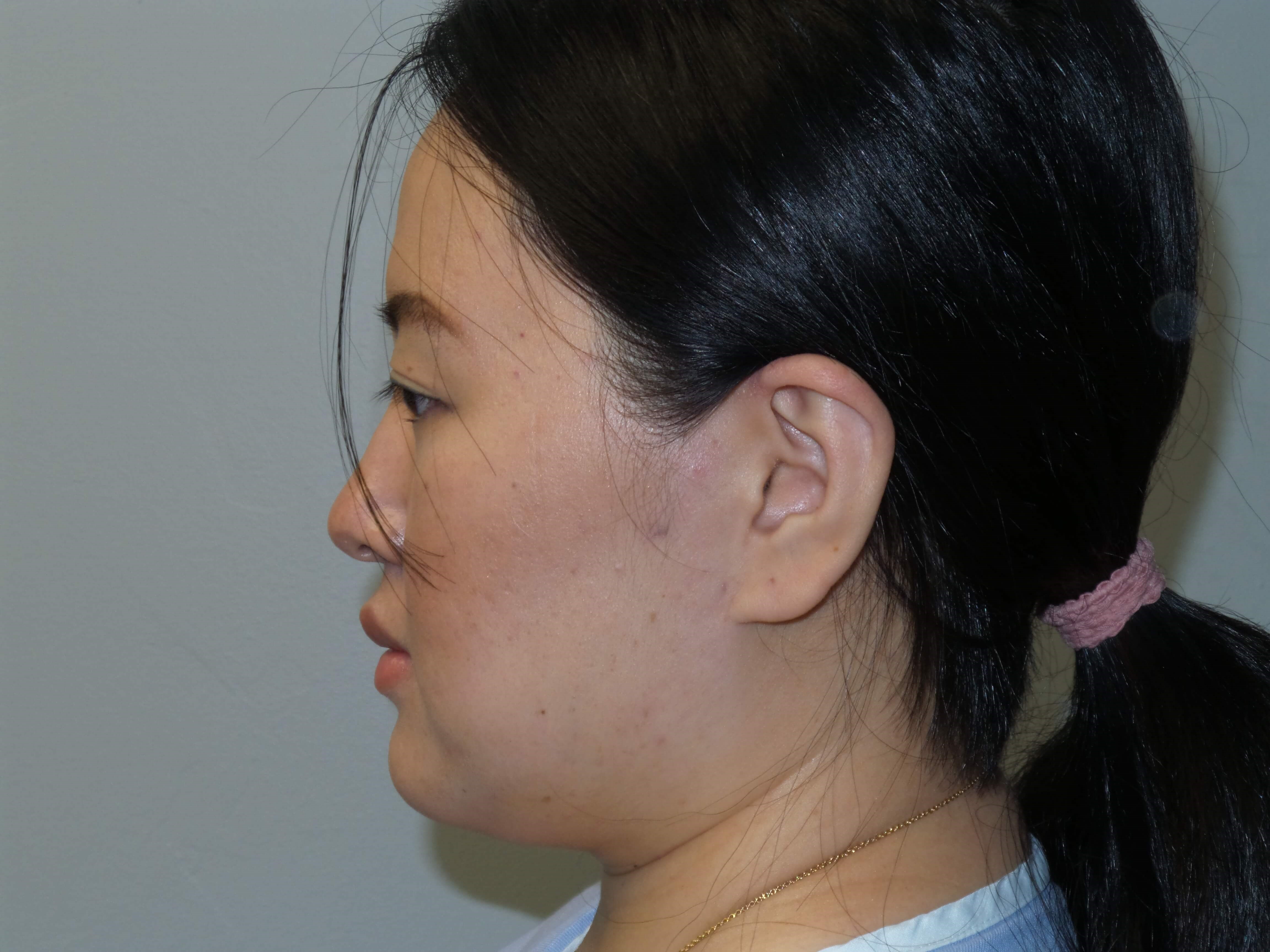 Woman has Neck Liposuction Before