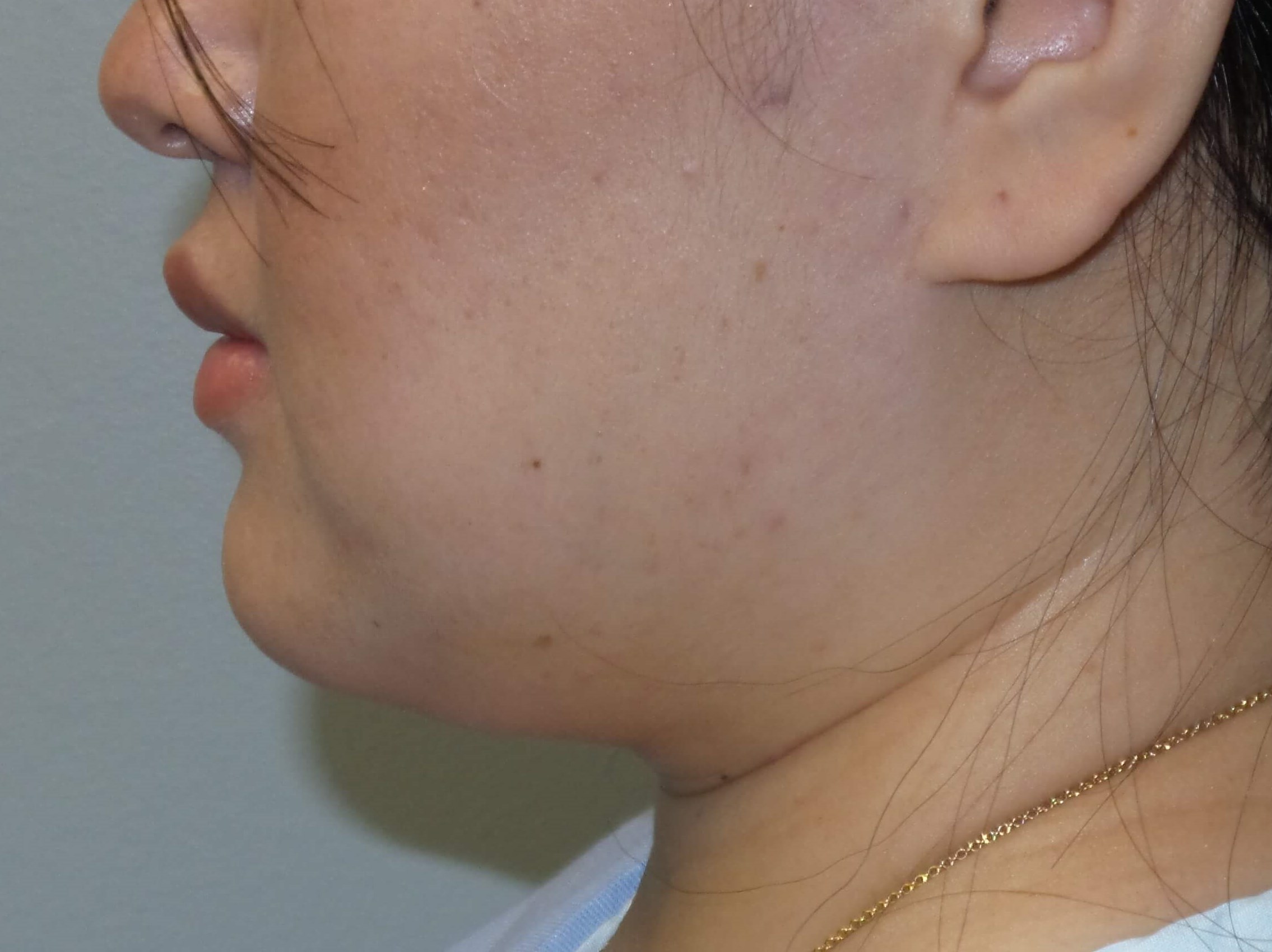 Woman has Neck Liposuction Before
