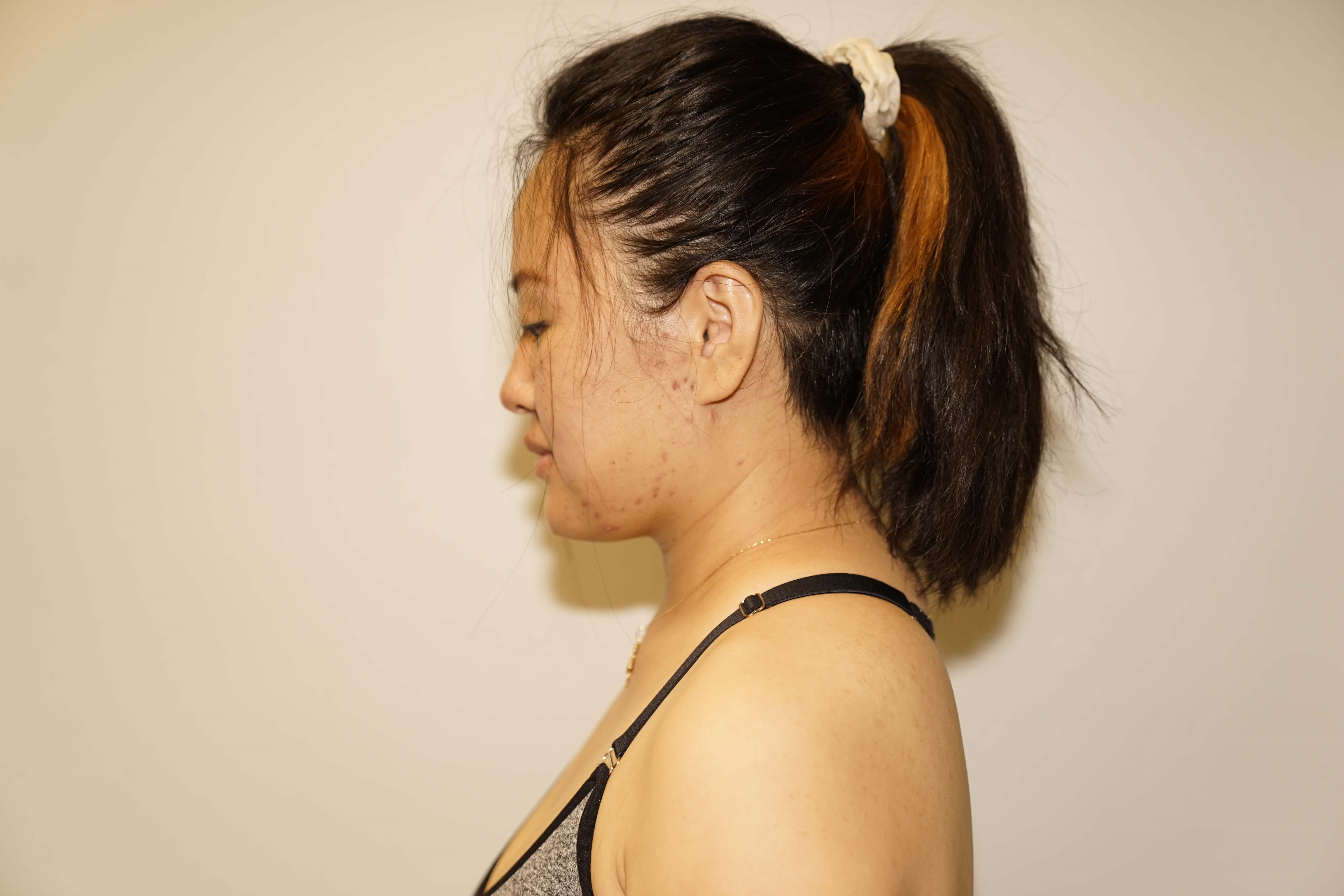 Woman has Neck Liposuction After