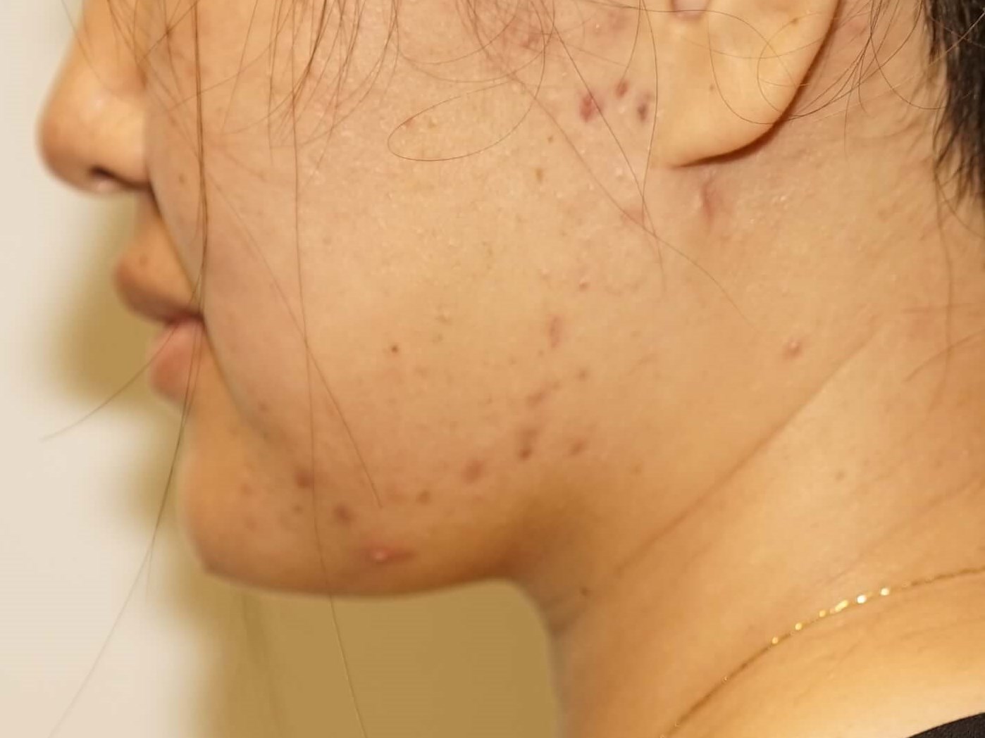 Woman has Neck Liposuction After