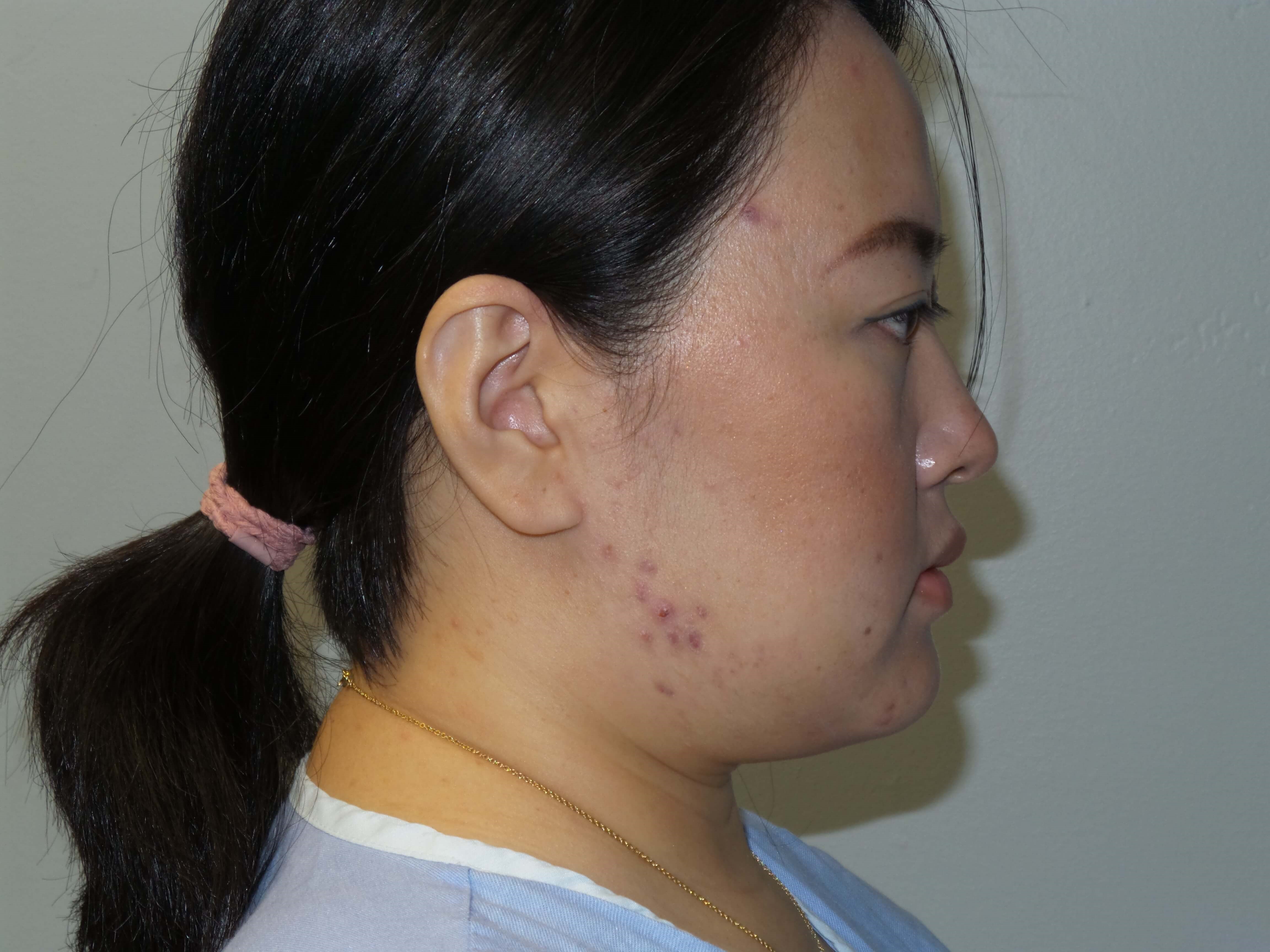 Woman has Neck Liposuction Before