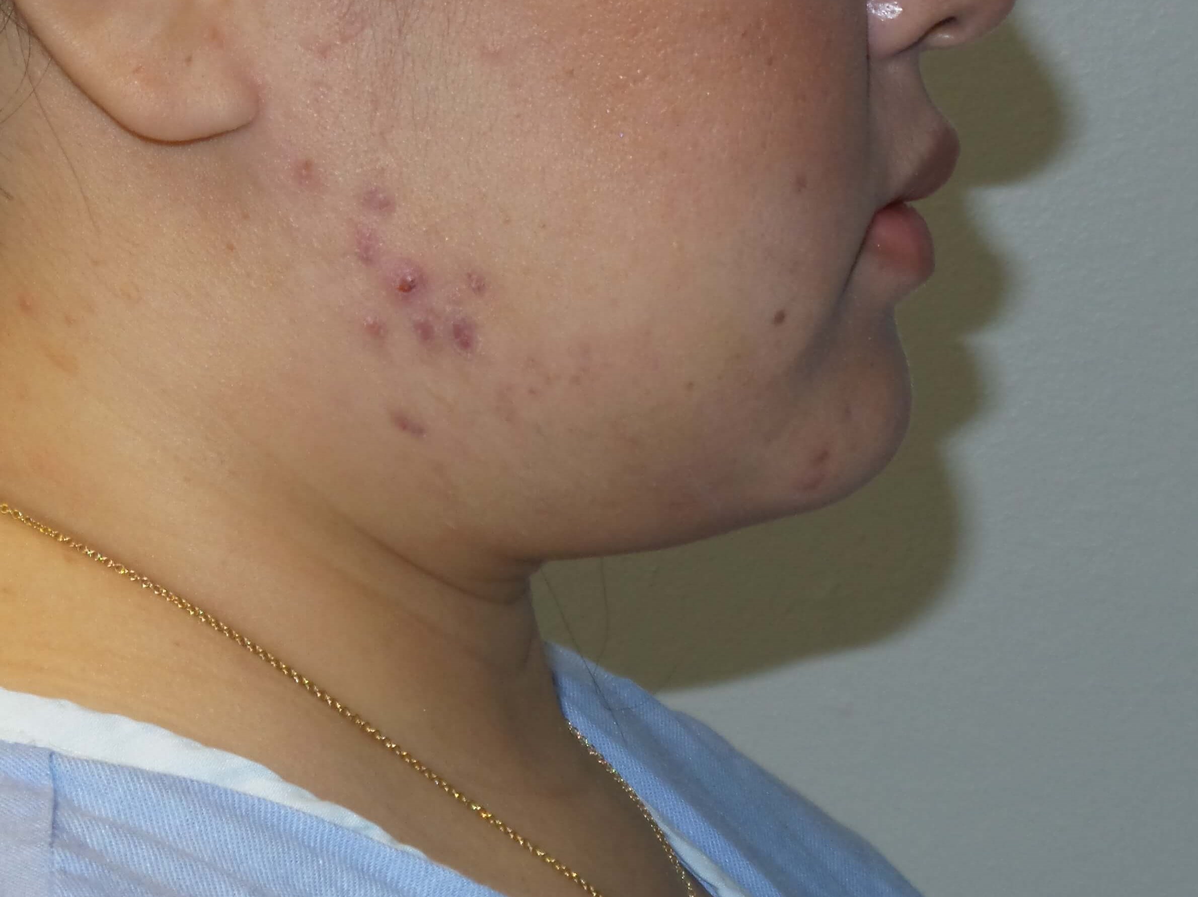Woman has Neck Liposuction Before