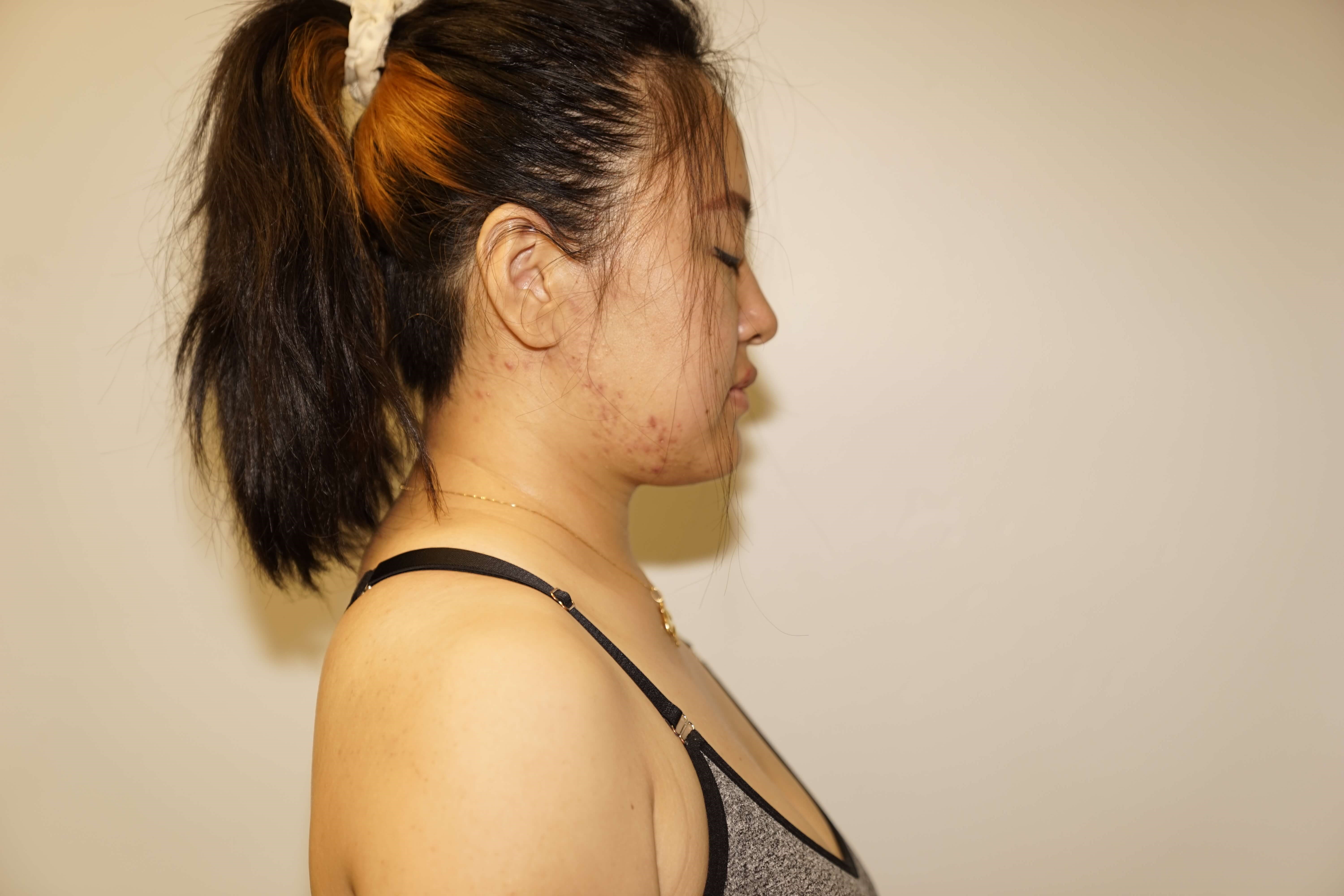 Woman has Neck Liposuction After