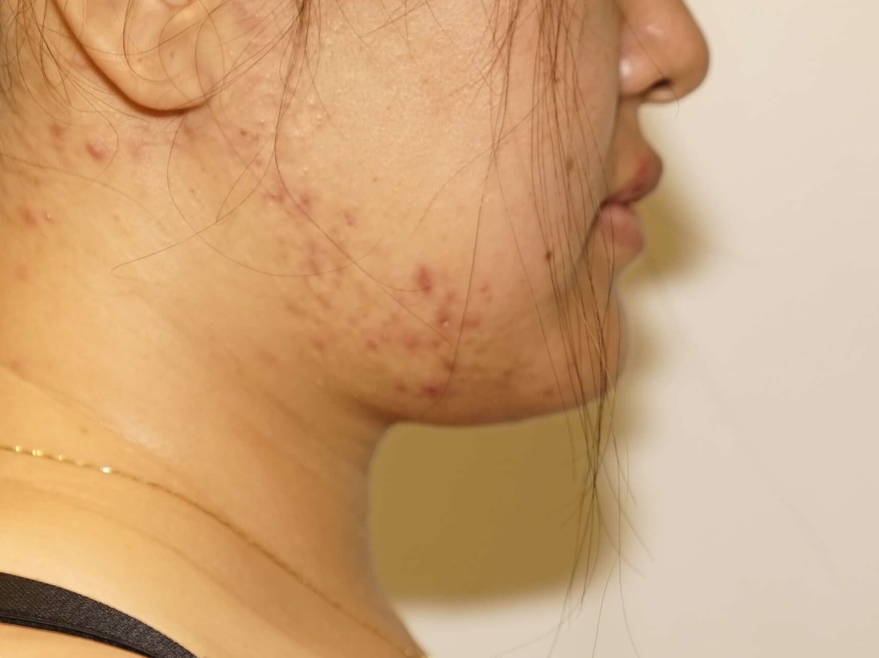 Woman has Neck Liposuction After