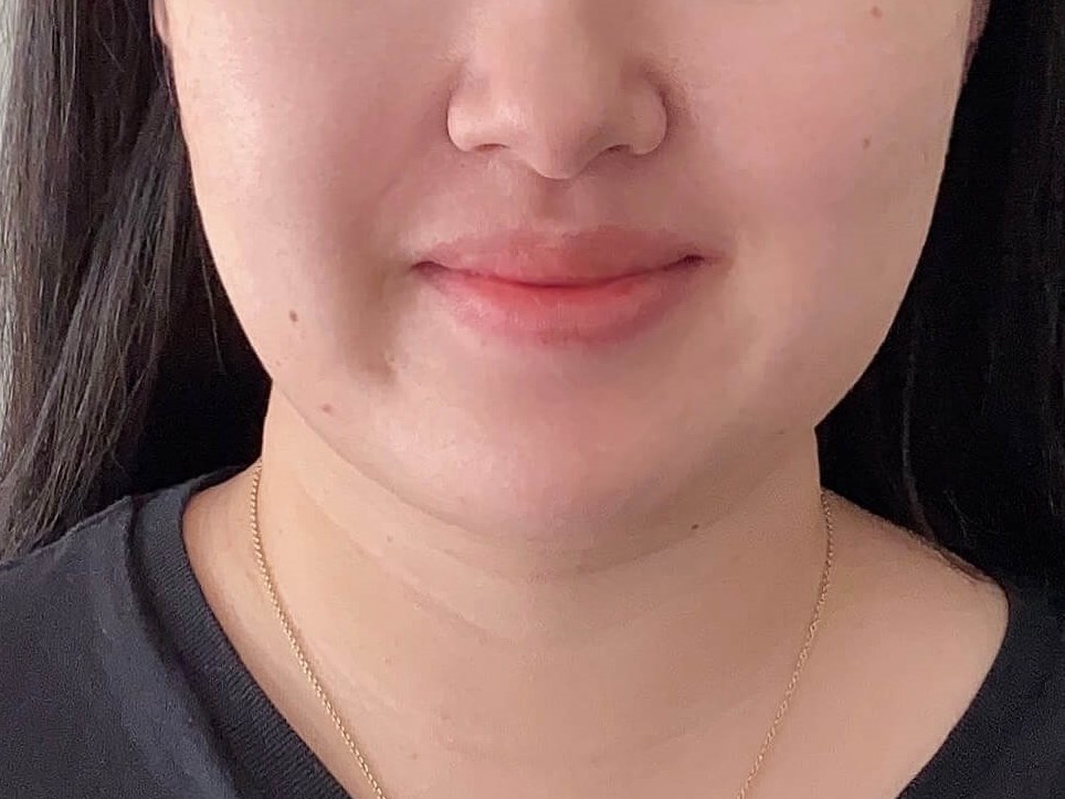 Woman has Neck Liposuction Before